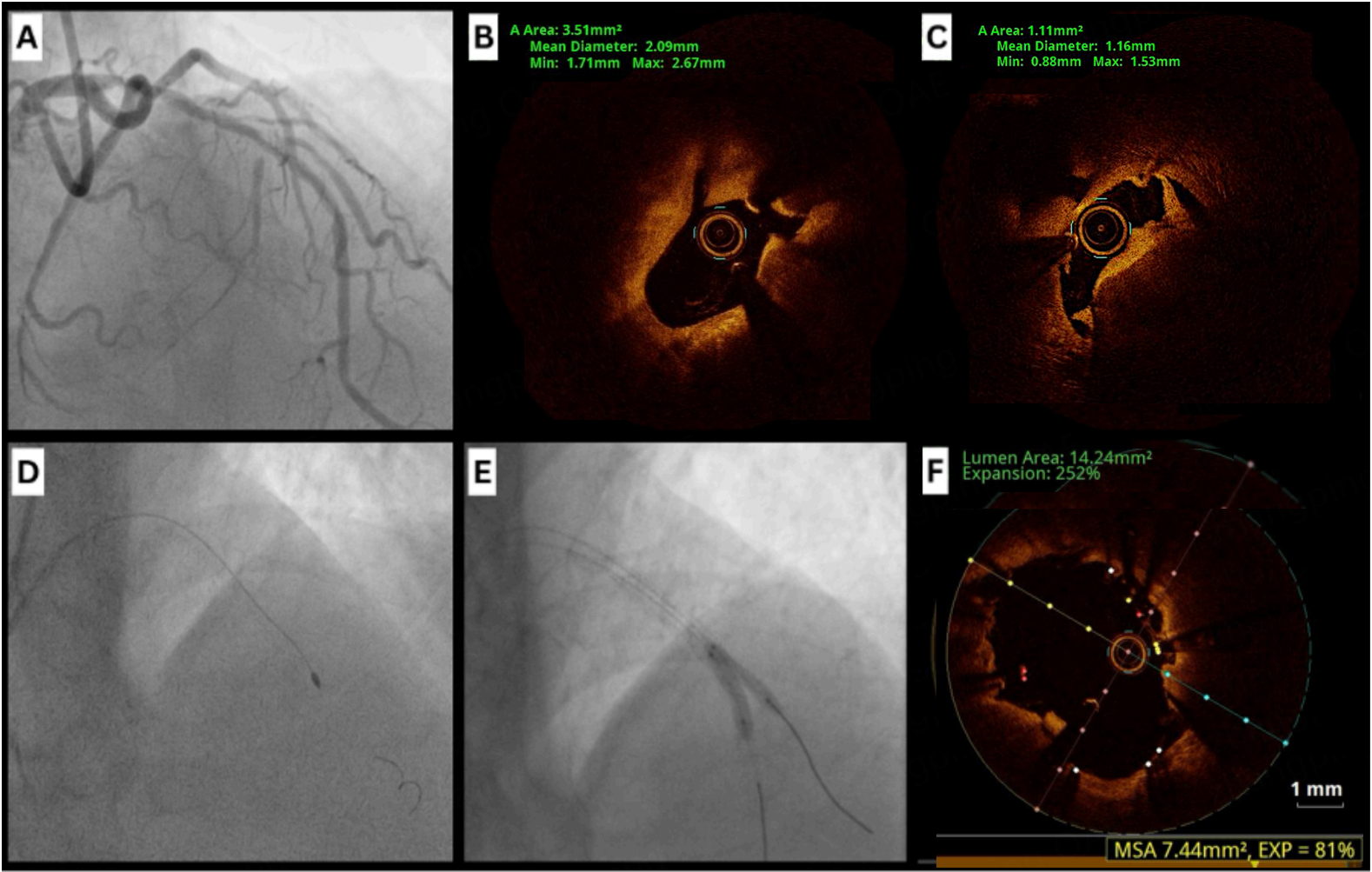 Calcified coronary nodules: pathophysiology, diagnosis, and interventional challenges