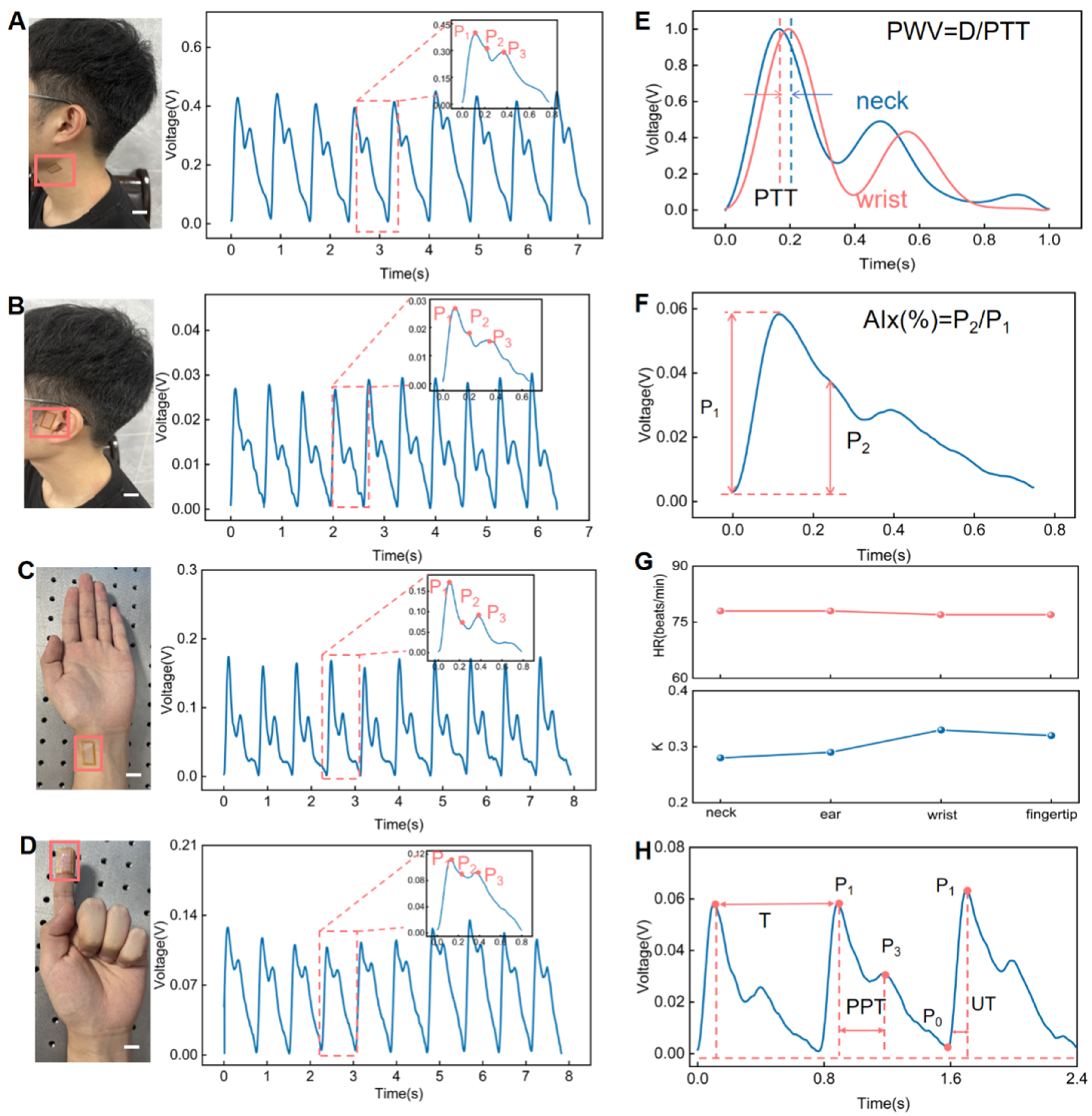 Island-bridge microstructured triboelectric pressure sensor for effective dynamic epidermal pulse monitoring