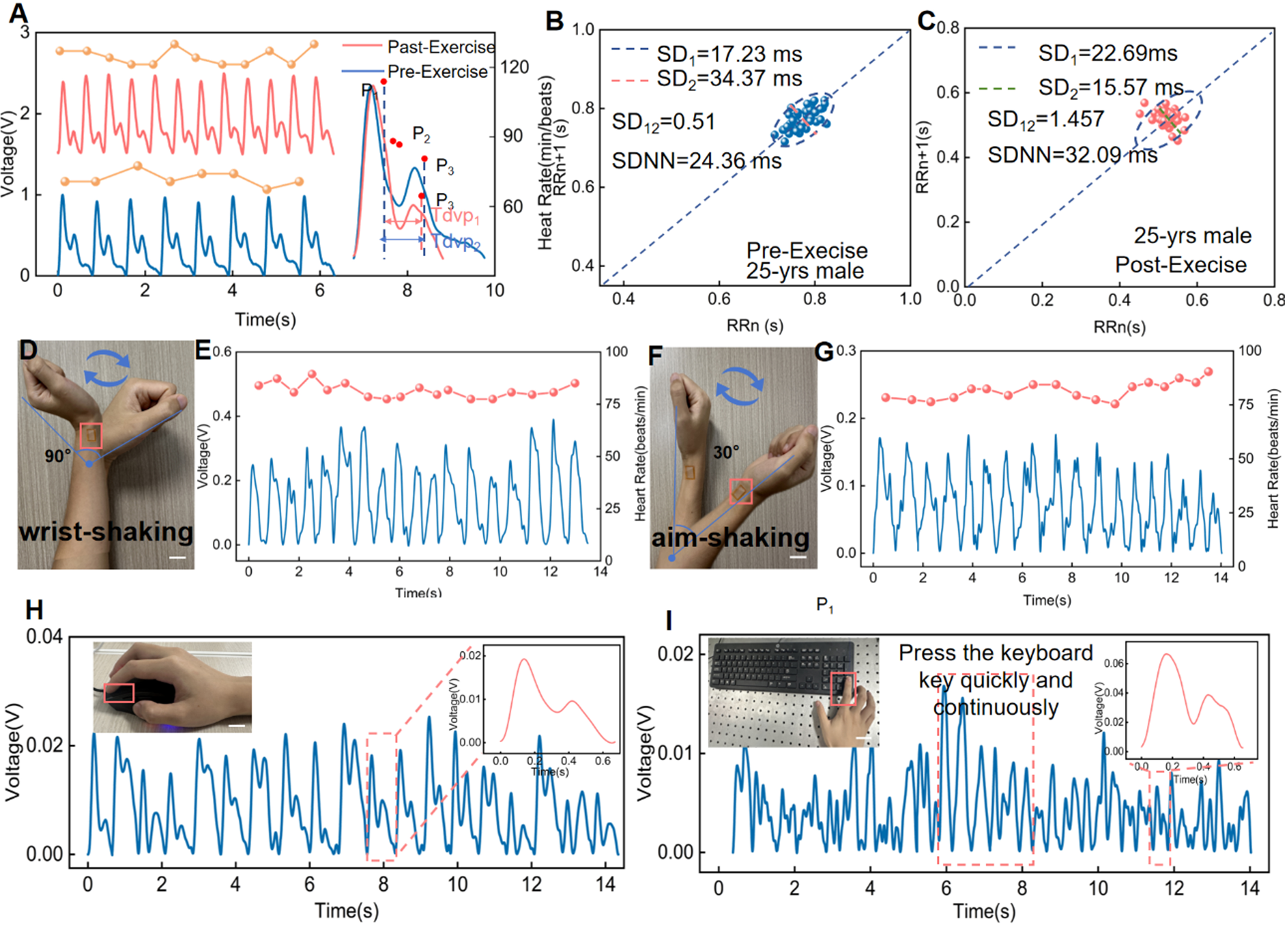 Island-bridge microstructured triboelectric pressure sensor for effective dynamic epidermal pulse monitoring