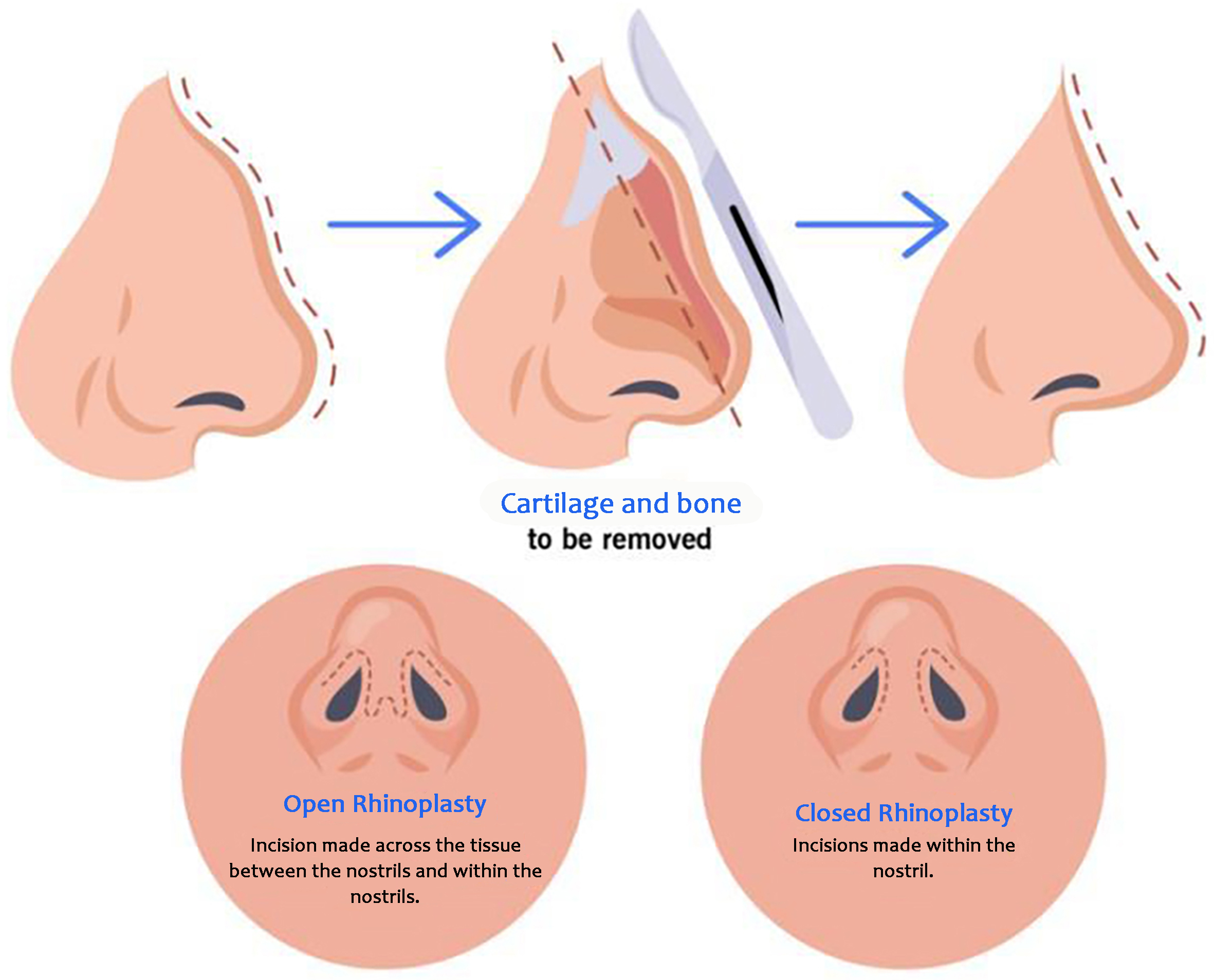 Intelligent augmented reality application for personalised rhinoplasty using machine learning