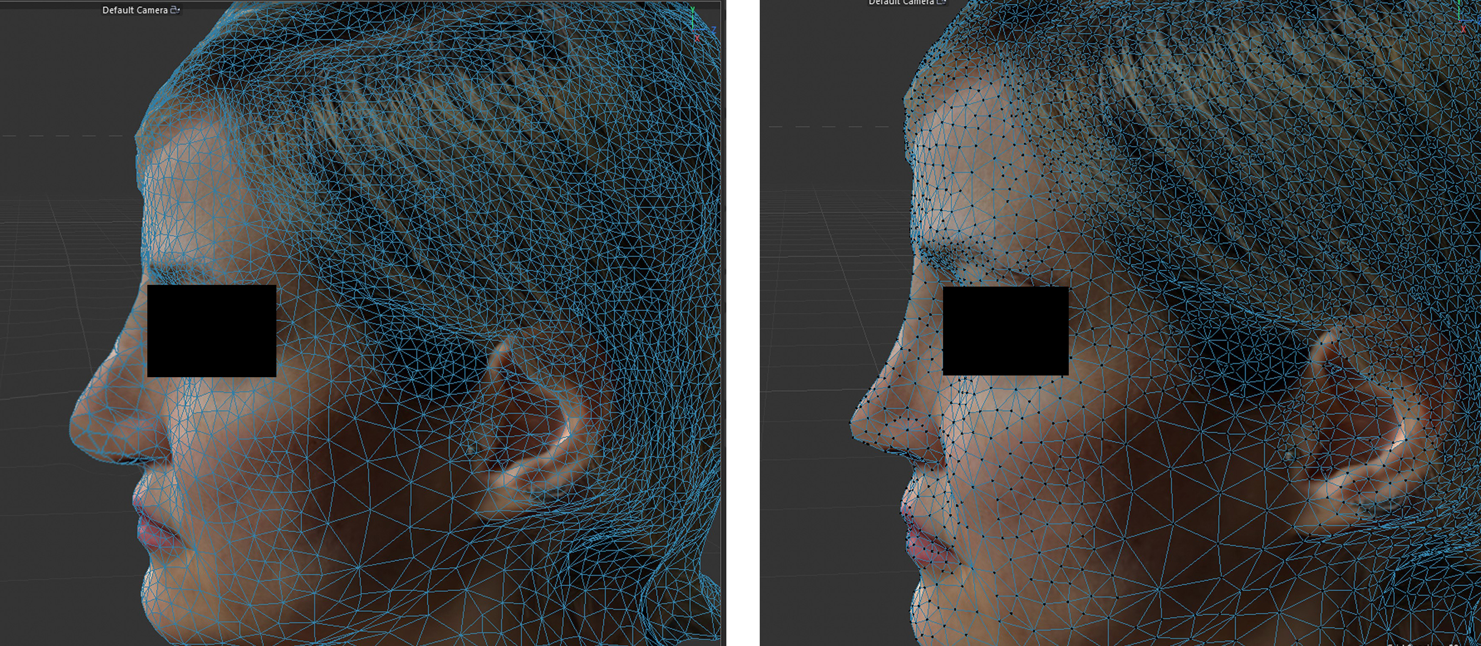 Intelligent augmented reality application for personalised rhinoplasty using machine learning