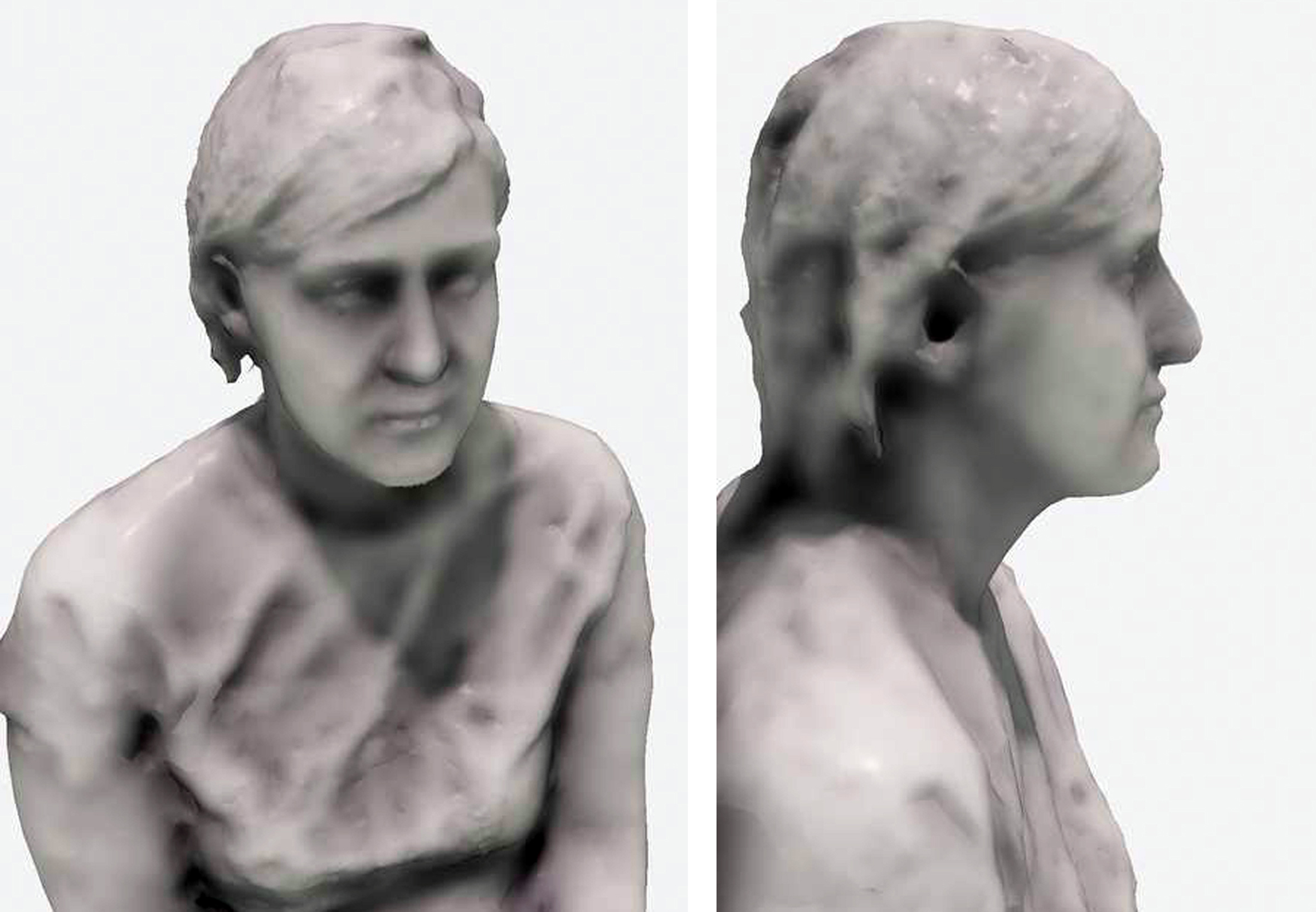 Intelligent augmented reality application for personalised rhinoplasty using machine learning