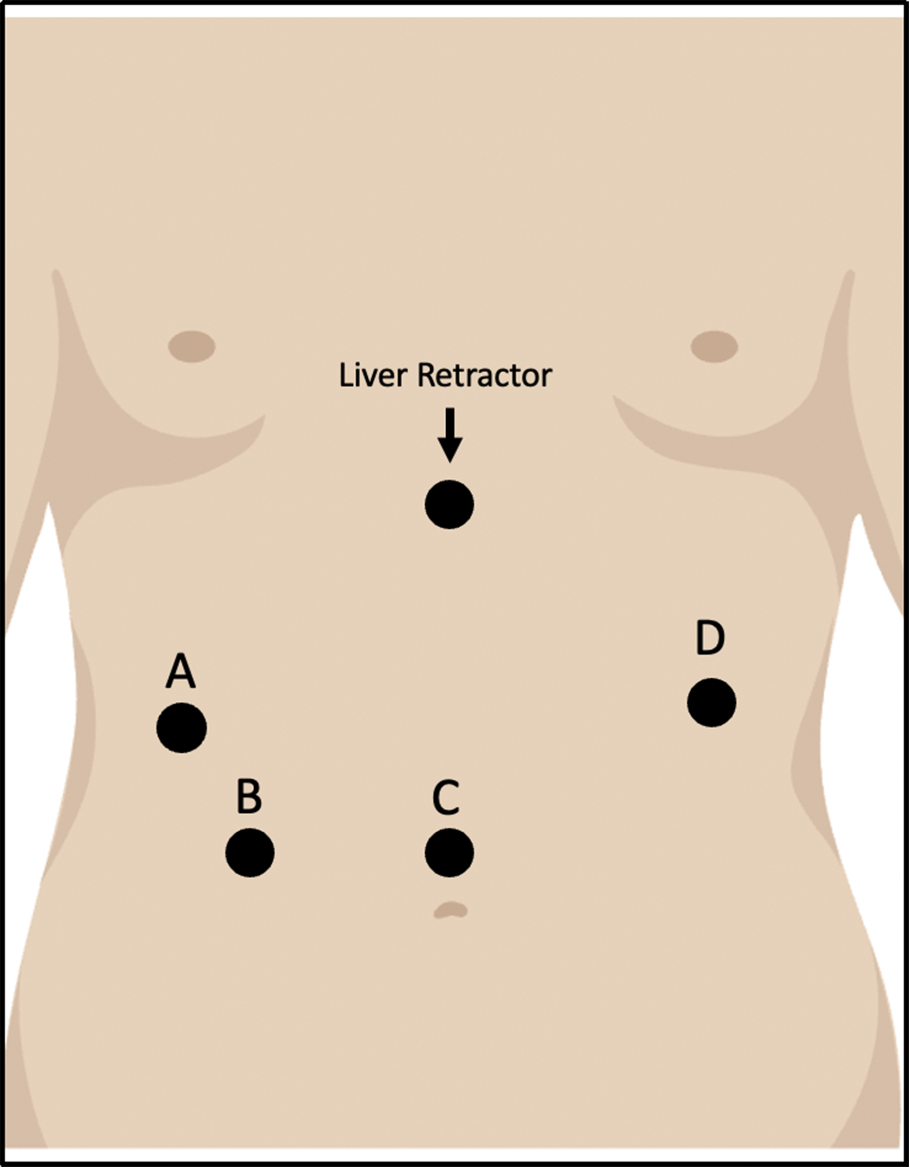 Robotic Heller myotomy and fundoplication - techniques and outcomes