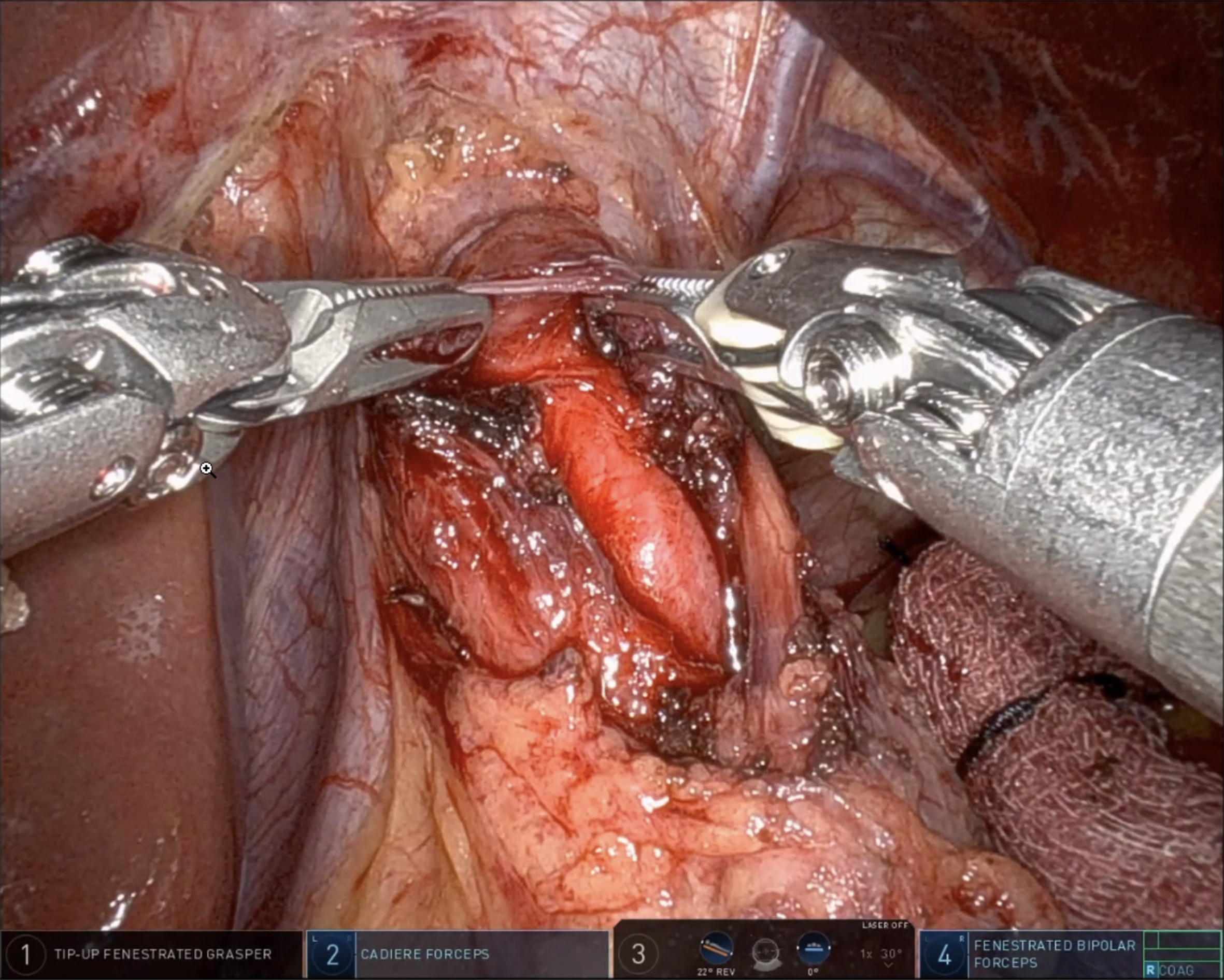 Robotic Heller myotomy and fundoplication - techniques and outcomes