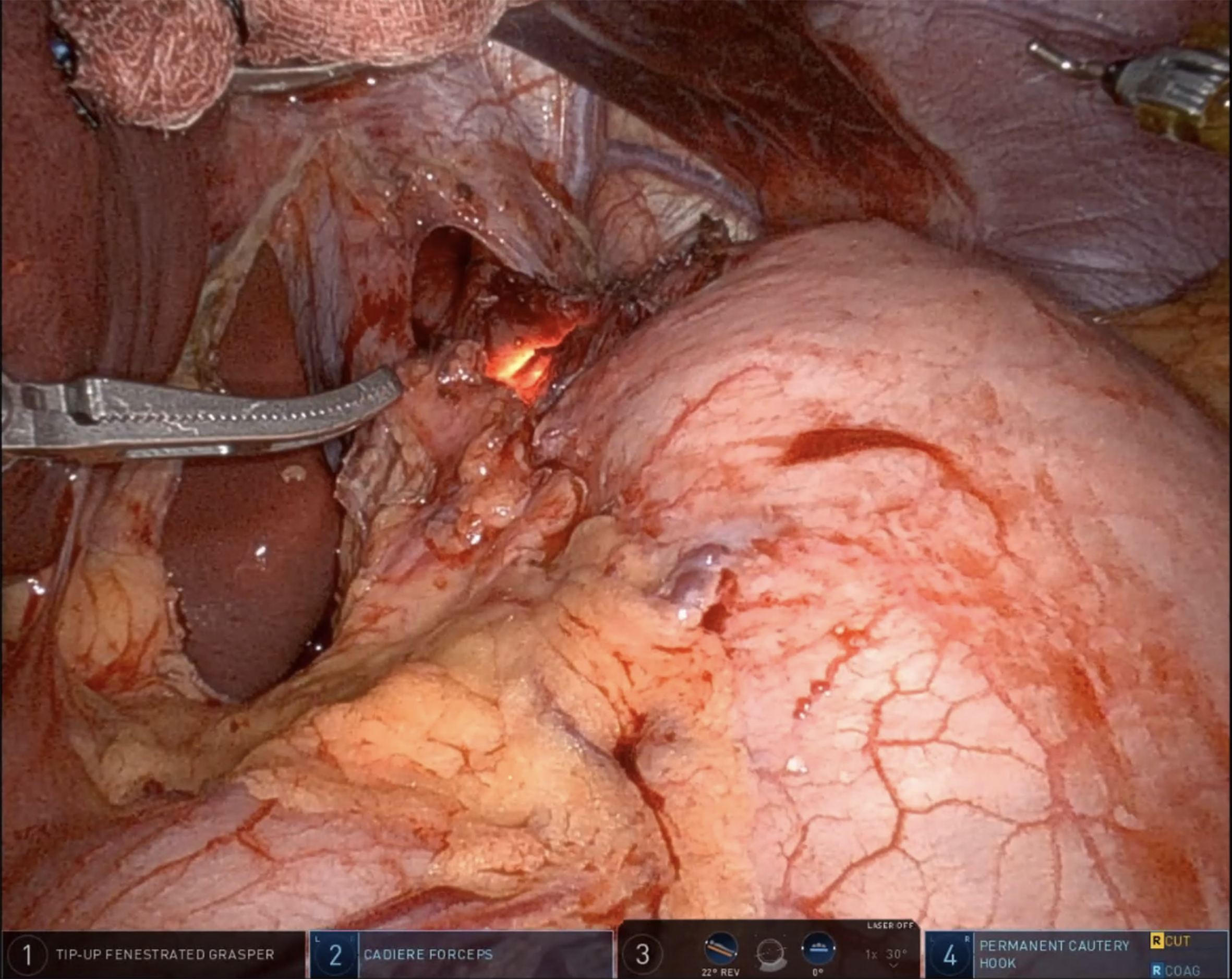Robotic Heller myotomy and fundoplication - techniques and outcomes