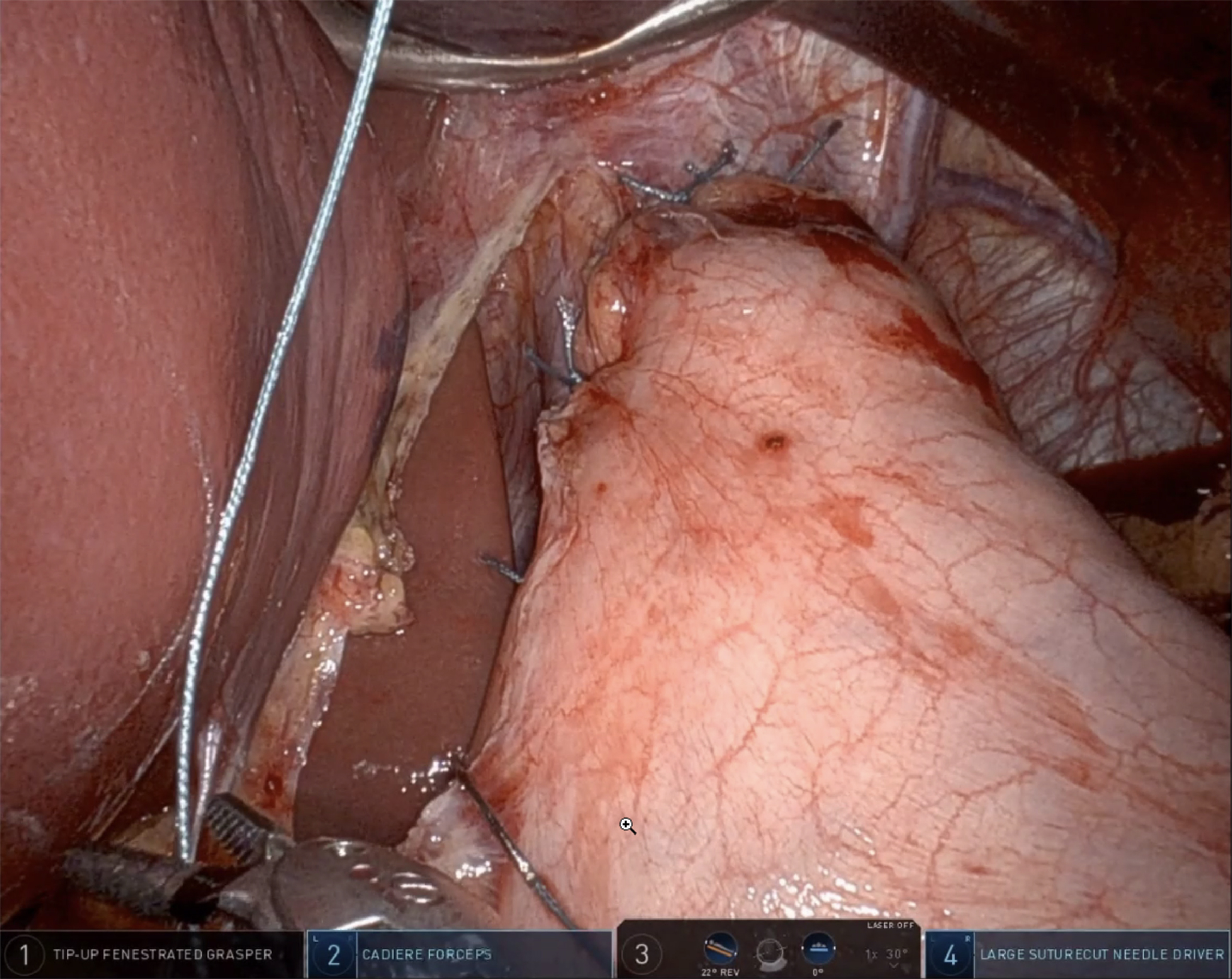 Robotic Heller myotomy and fundoplication - techniques and outcomes