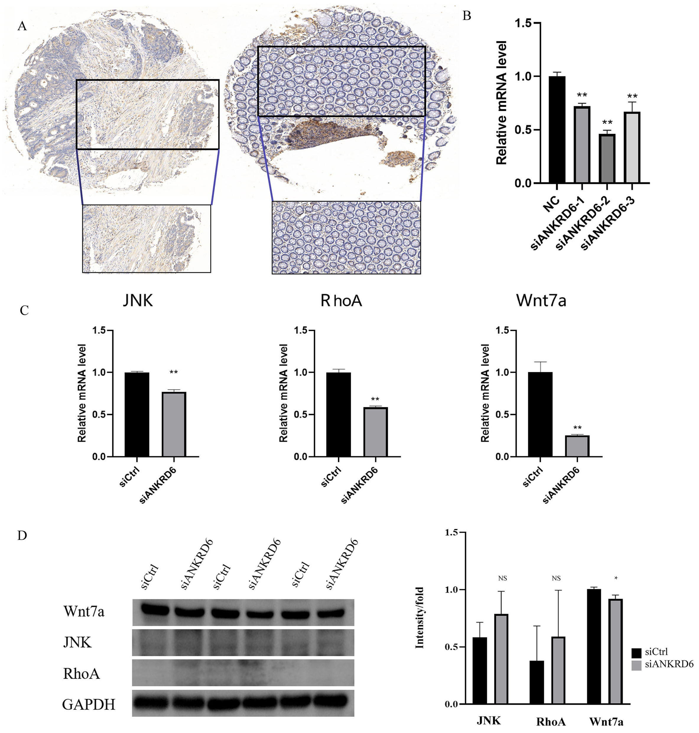 Differential expression and prognostic significance of ANKRD6 in colon adenocarcinoma: a pan-cancer analysis and pathway-specific investigation