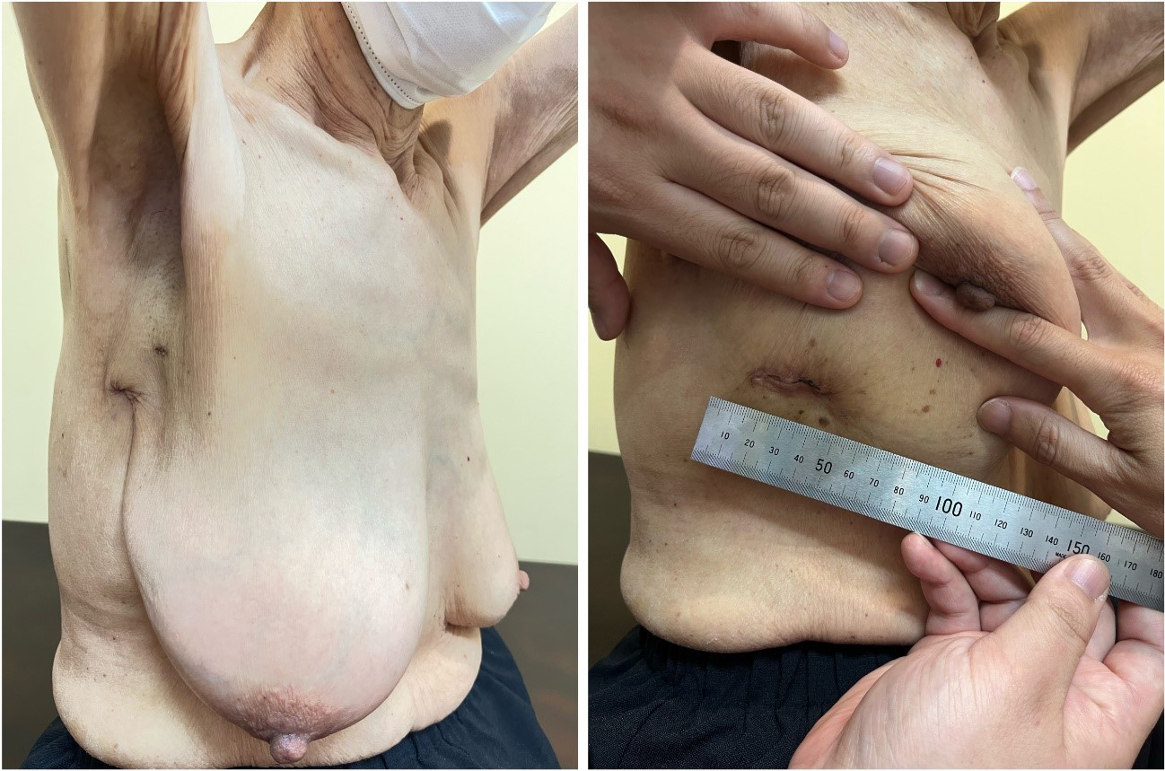 Totally endoscopic mitral valve repair employing the ten-loop technique for Barlow’s disease