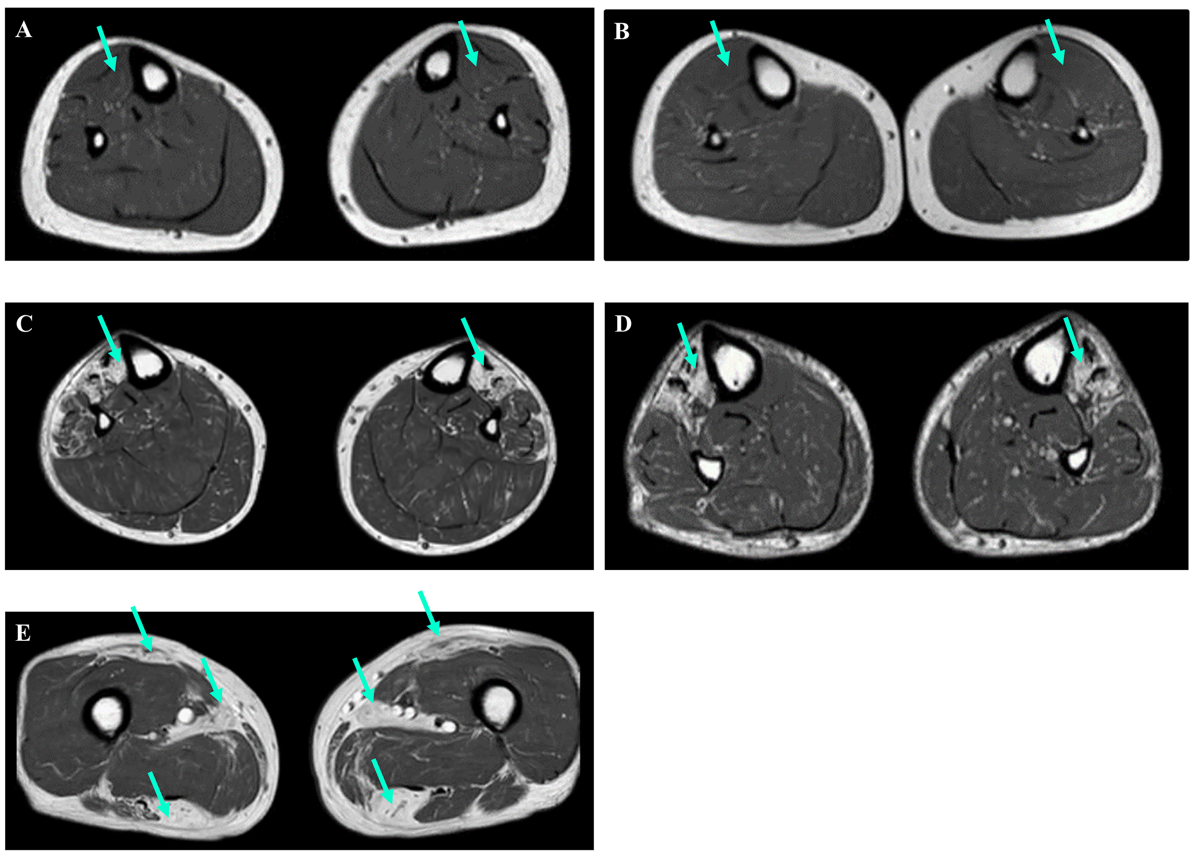 Autosomal dominant tibial muscular dystrophy in Estonia