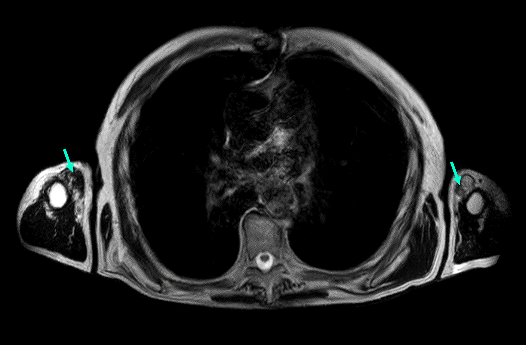 Autosomal dominant tibial muscular dystrophy in Estonia