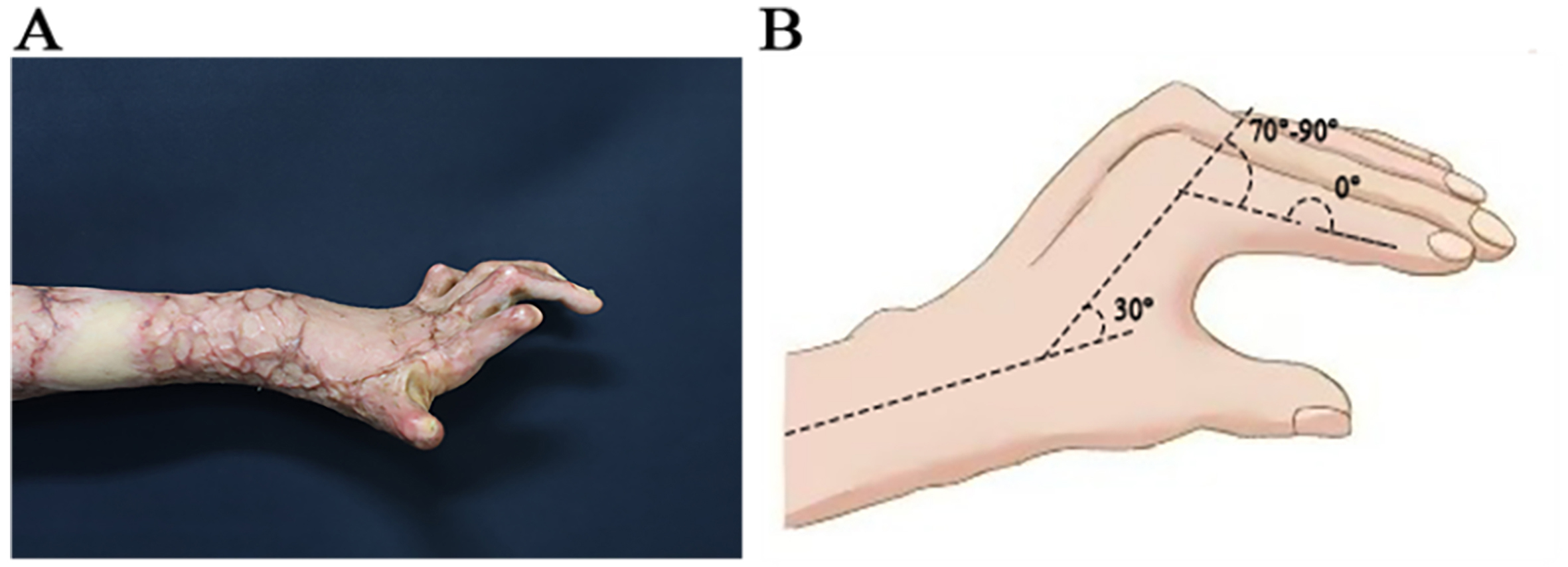 Asymmetric spindle skin harvesting combined with continuous Z skin grafting: experience in correcting metacarpophalangeal joint dorsiflexion deformities