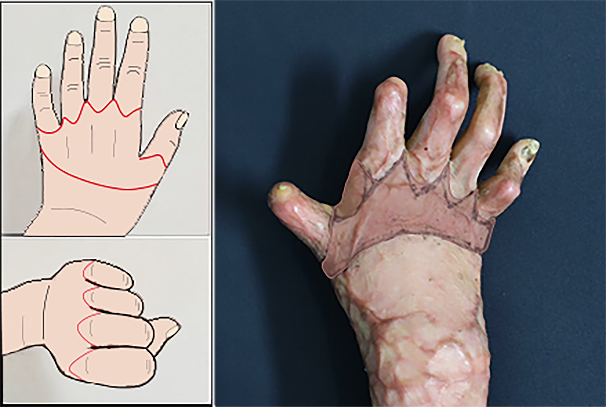 Asymmetric spindle skin harvesting combined with continuous Z skin grafting: experience in correcting metacarpophalangeal joint dorsiflexion deformities