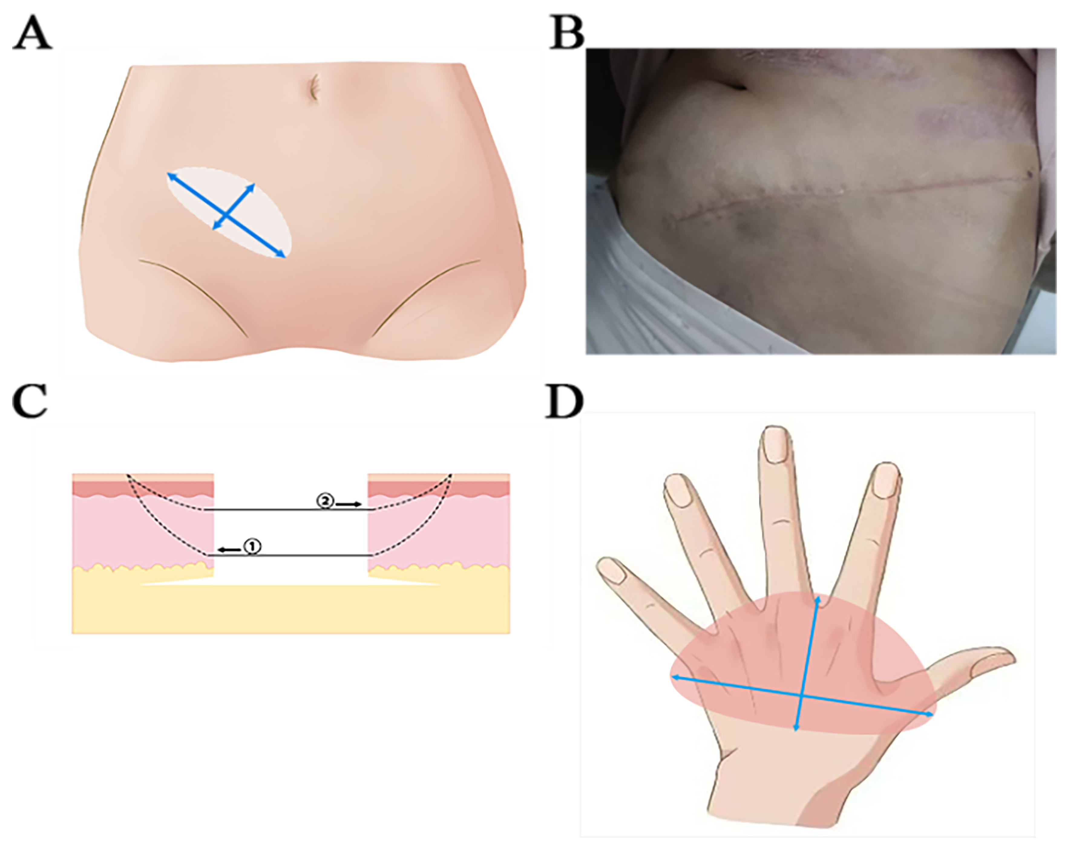 Asymmetric spindle skin harvesting combined with continuous Z skin grafting: experience in correcting metacarpophalangeal joint dorsiflexion deformities