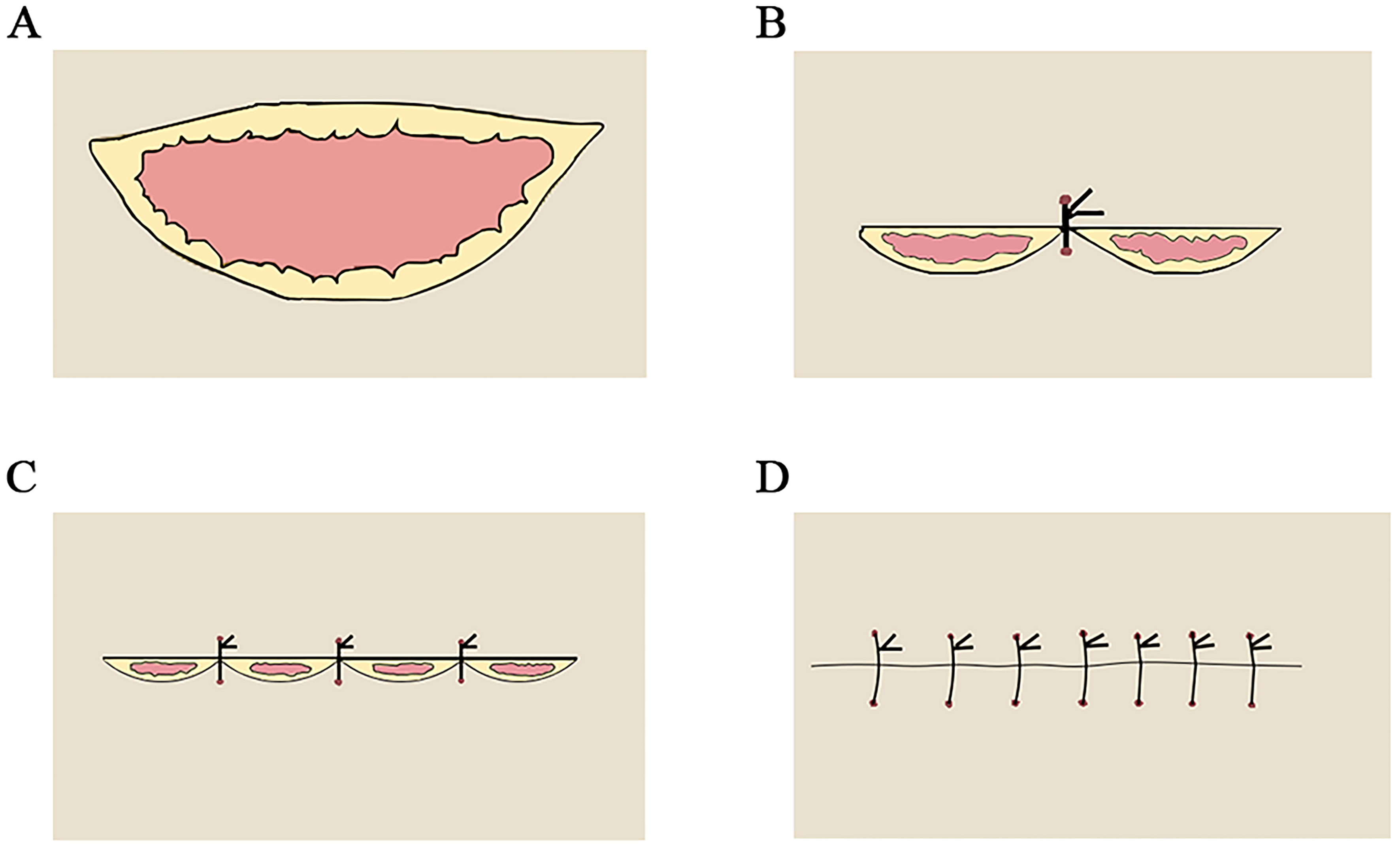 Asymmetric spindle skin harvesting combined with continuous Z skin grafting: experience in correcting metacarpophalangeal joint dorsiflexion deformities