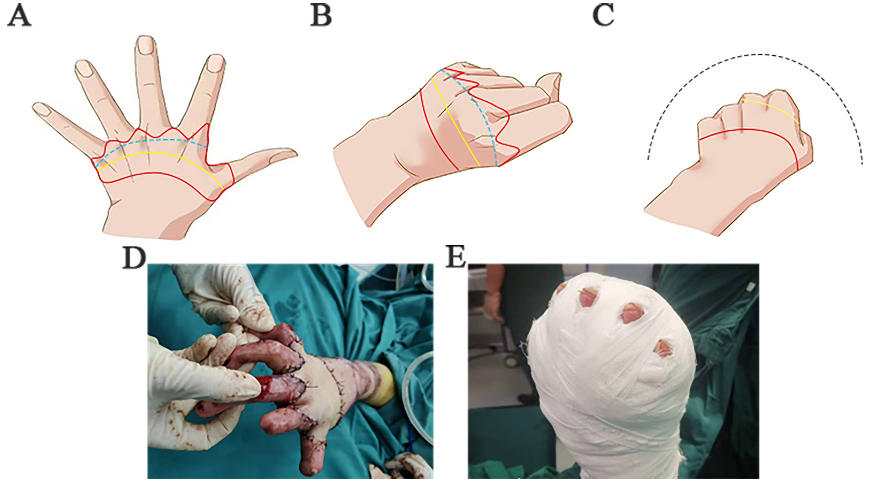 Asymmetric spindle skin harvesting combined with continuous Z skin grafting: experience in correcting metacarpophalangeal joint dorsiflexion deformities