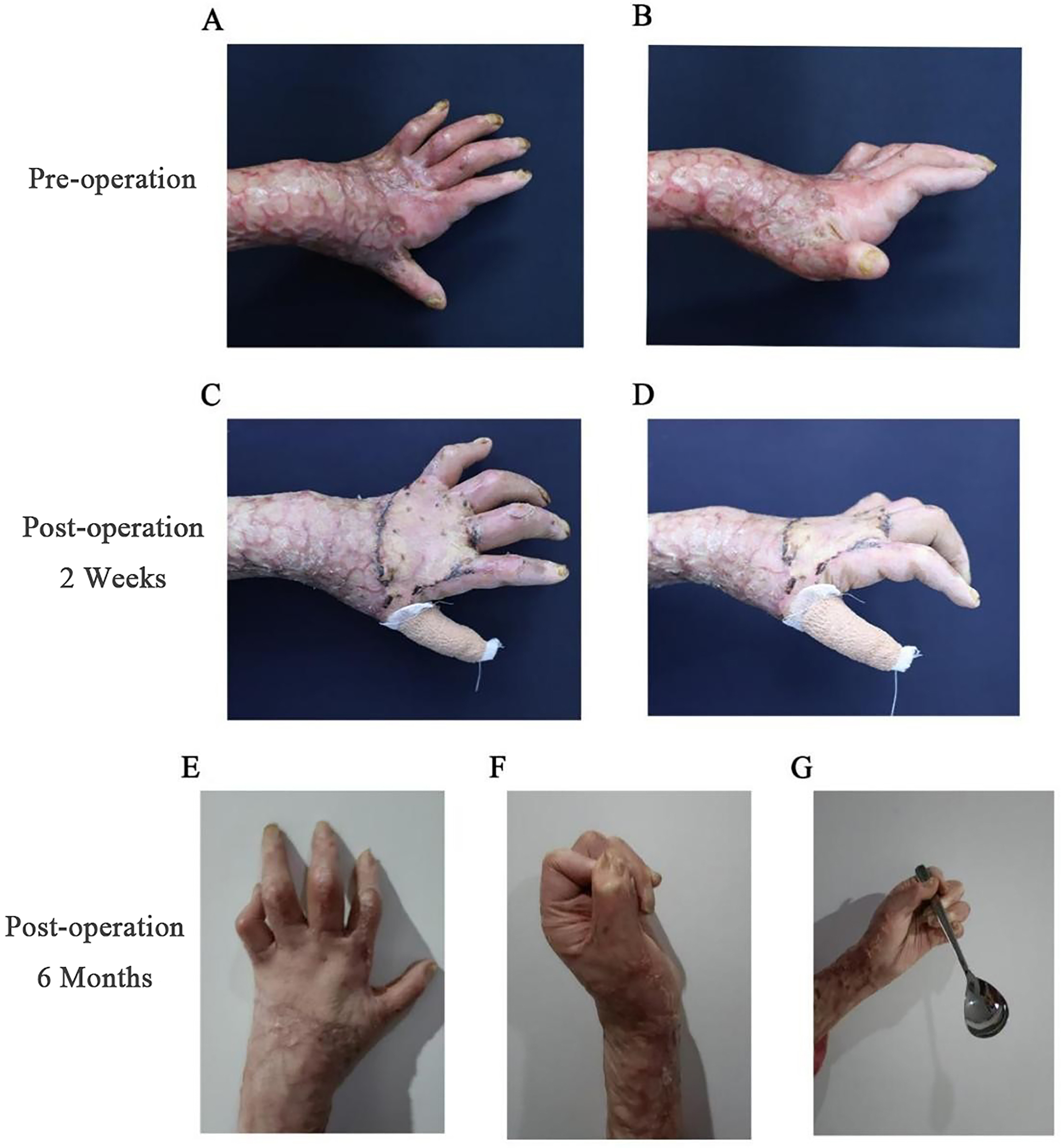 Asymmetric spindle skin harvesting combined with continuous Z skin grafting: experience in correcting metacarpophalangeal joint dorsiflexion deformities