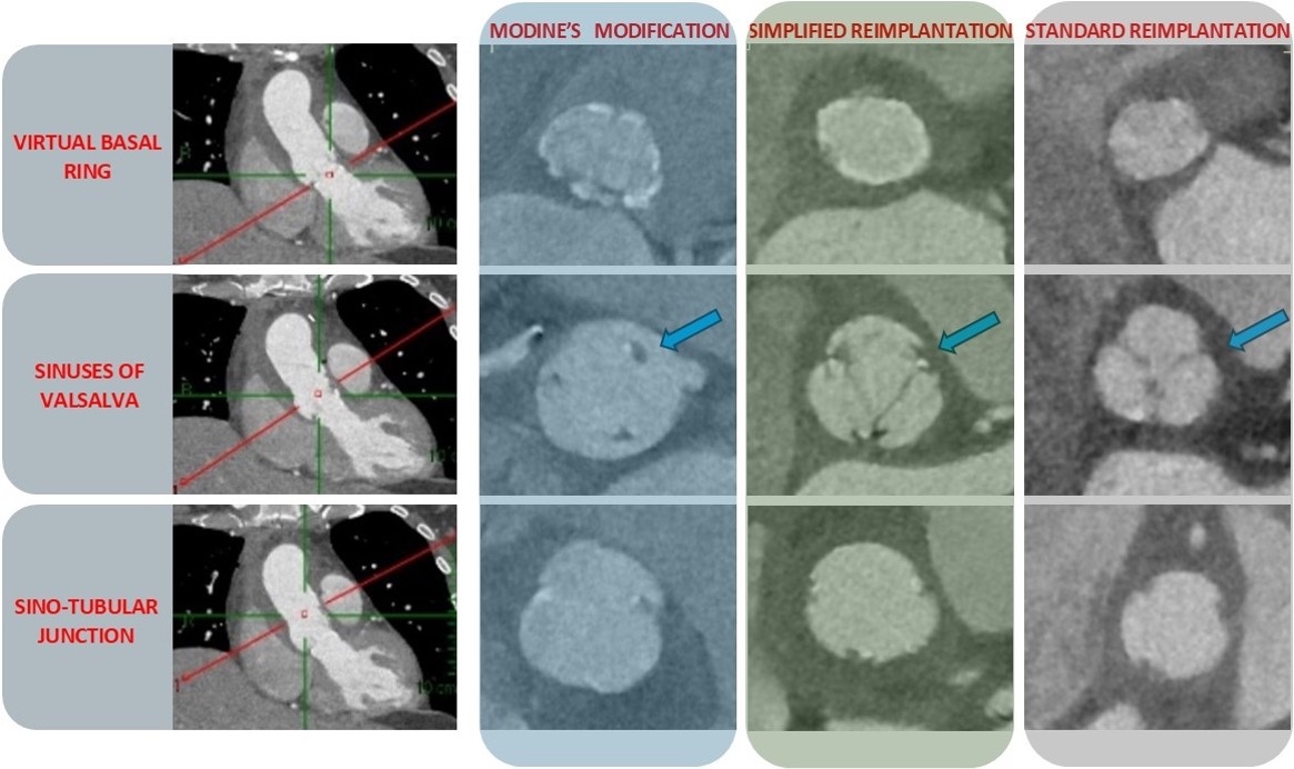 Comparison of the “Modine modification” with the standard reimplantation technique: indications and options for improvement