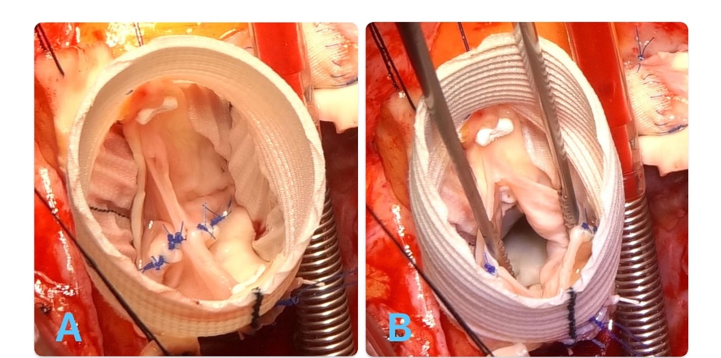 Comparison of the “Modine modification” with the standard reimplantation technique: indications and options for improvement