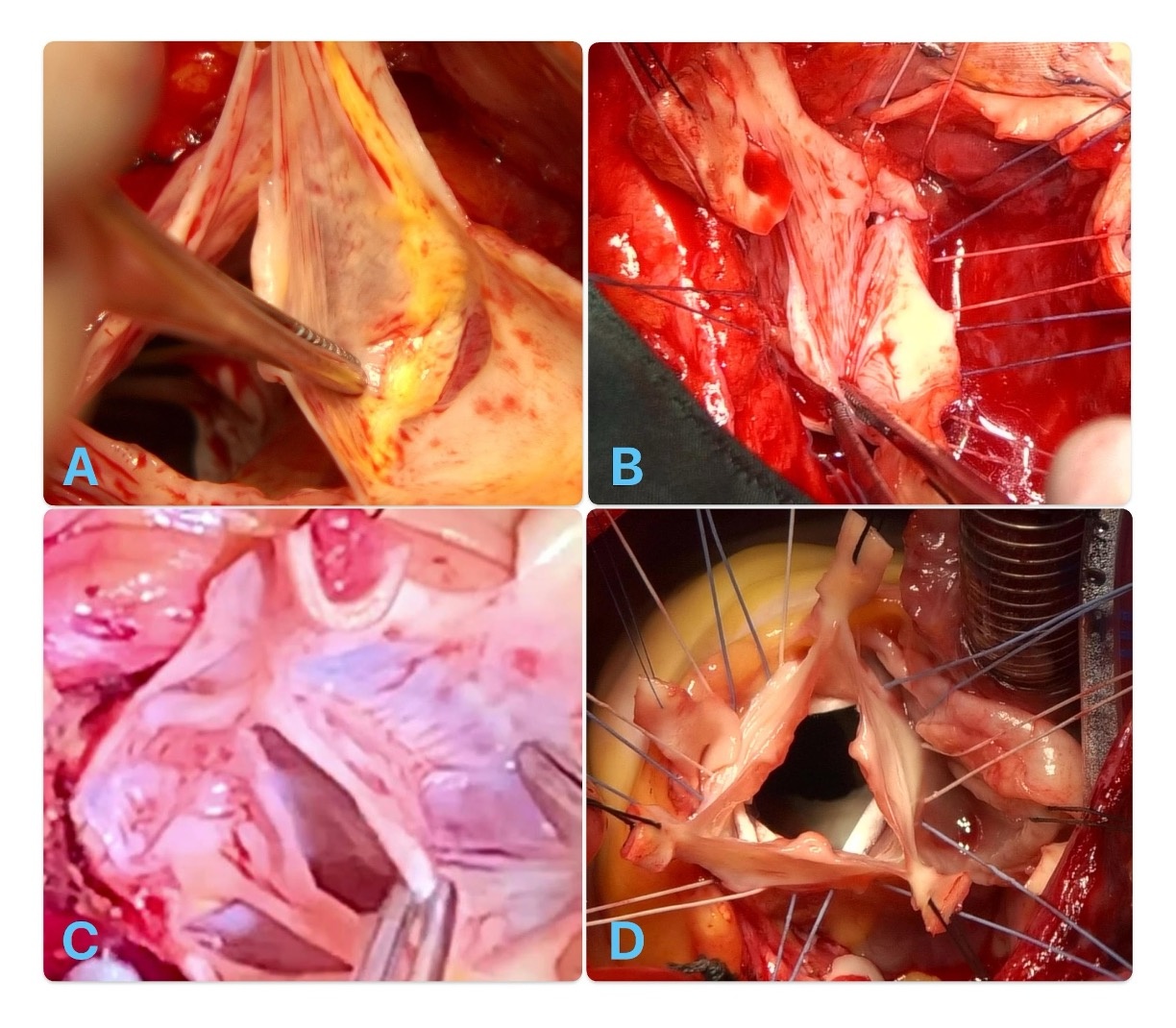 Comparison of the “Modine modification” with the standard reimplantation technique: indications and options for improvement