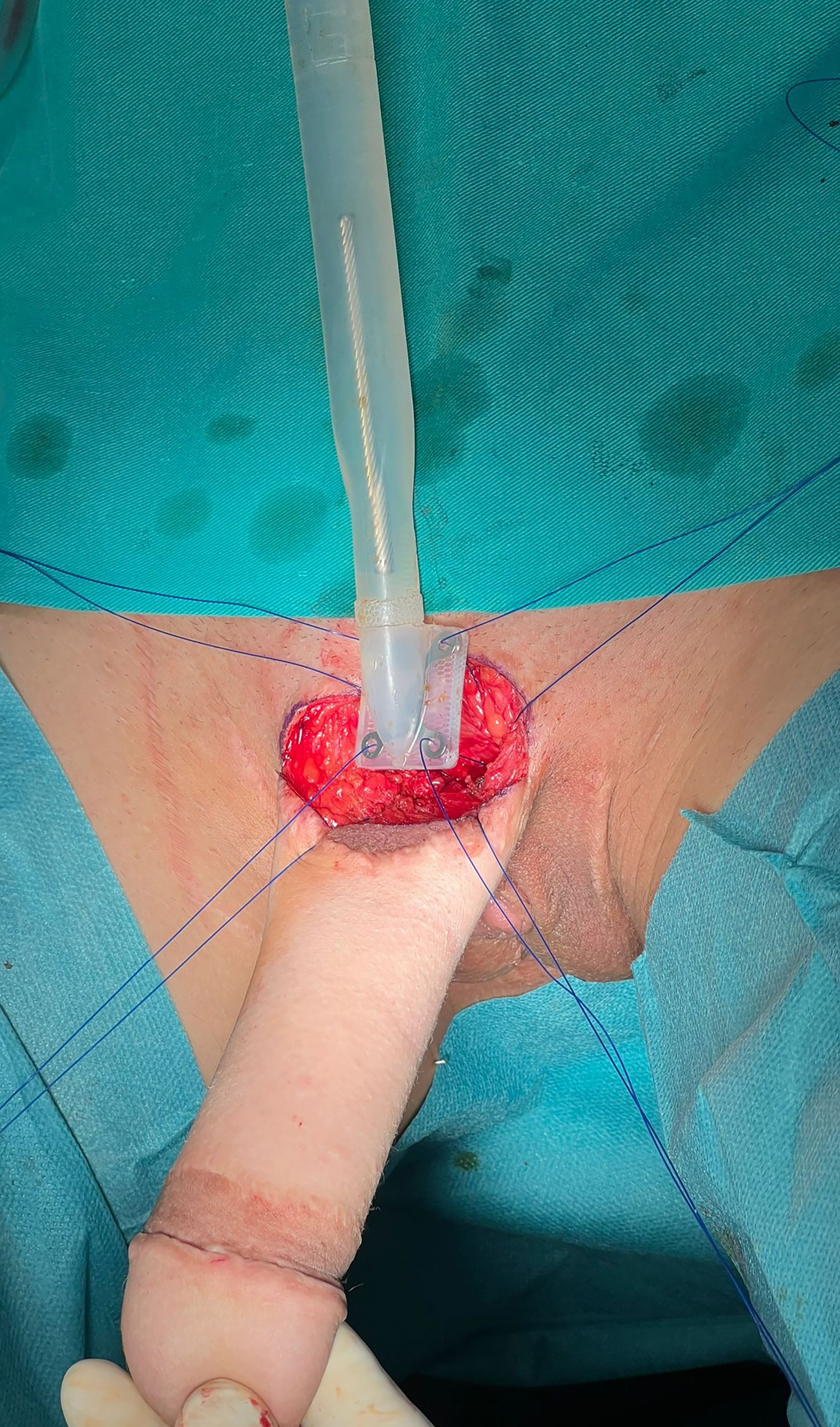 Novel penile prostheses for transmen: surgical outcomes of ZSI FTM penile implants after musculocutaneous latissimus dorsi neophalloplasty
