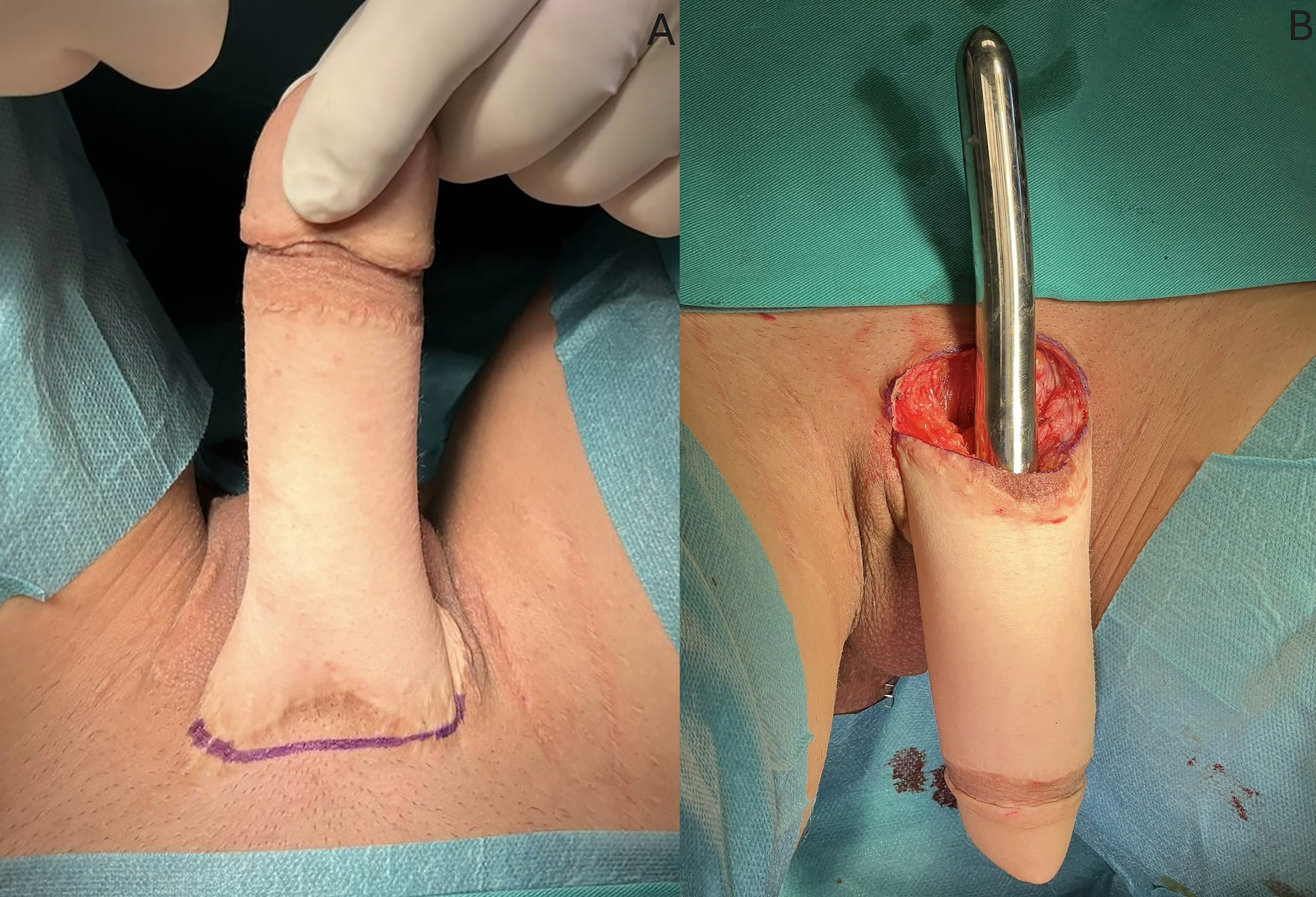 Novel penile prostheses for transmen: surgical outcomes of ZSI FTM penile implants after musculocutaneous latissimus dorsi neophalloplasty