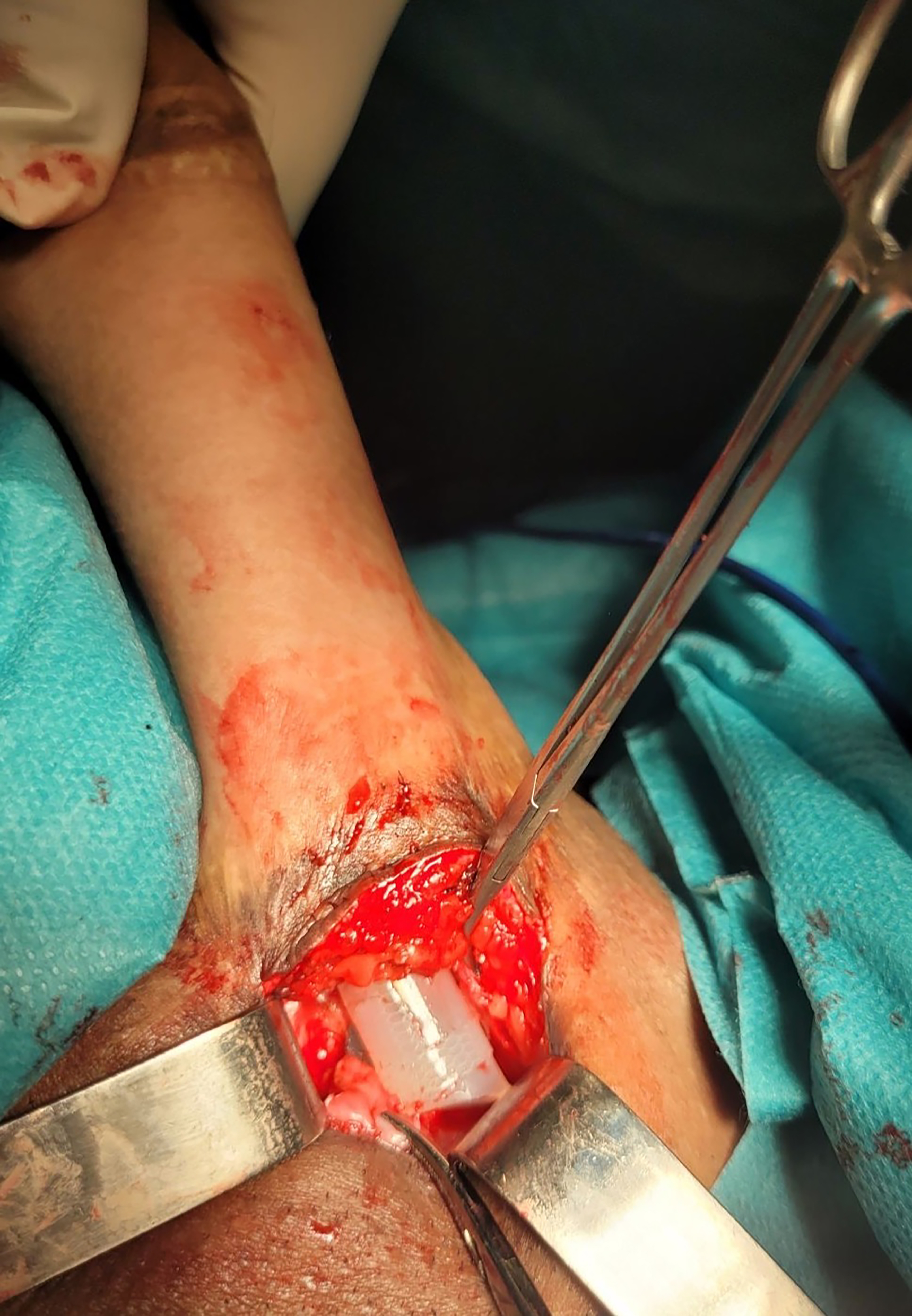 Novel penile prostheses for transmen: surgical outcomes of ZSI FTM penile implants after musculocutaneous latissimus dorsi neophalloplasty