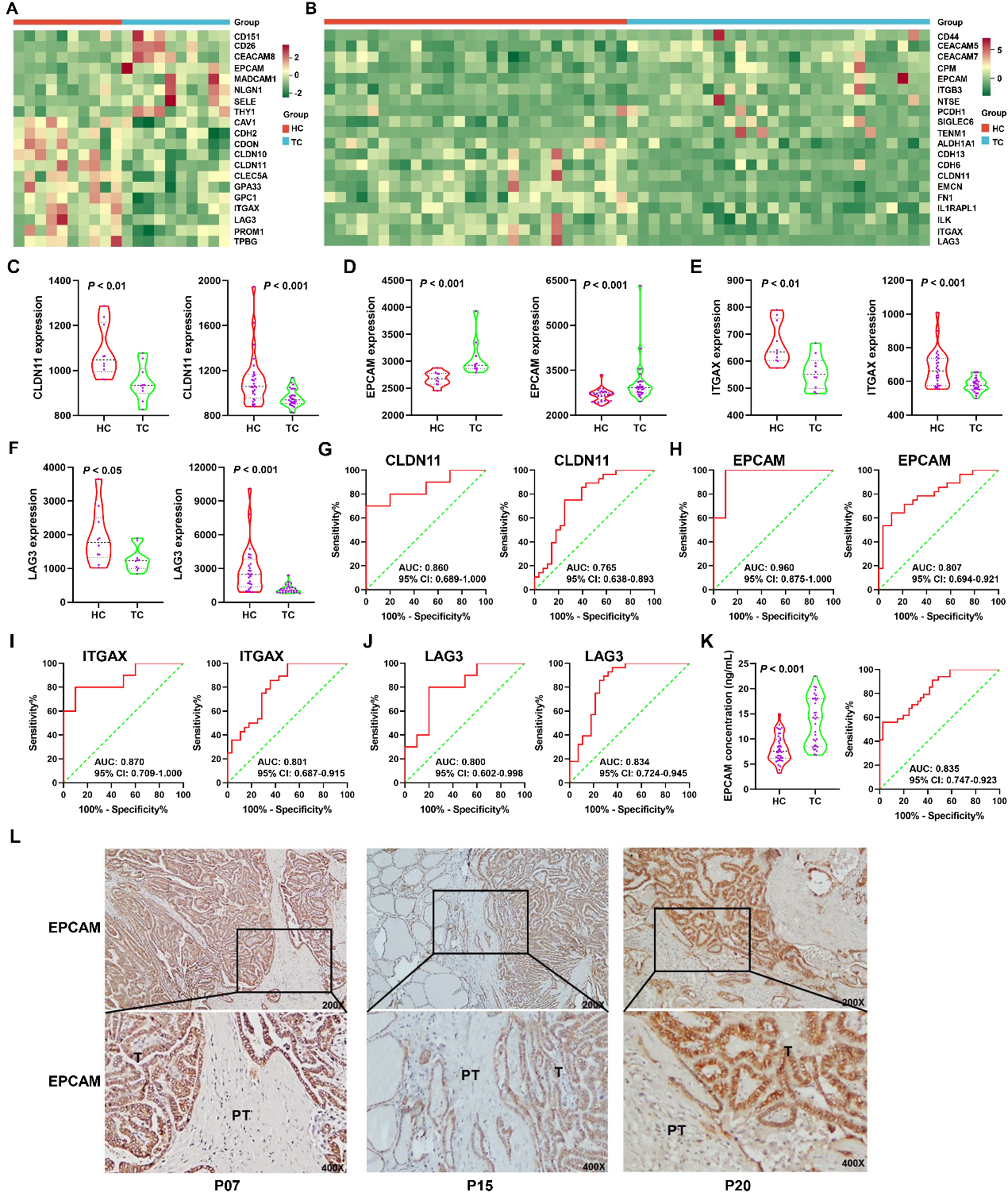 A single-sEV analysis identifies plasma EPCAM<sup>+</sup> sEVs as a biomarker for early diagnosis and monitoring postoperative remission of thyroid cancer