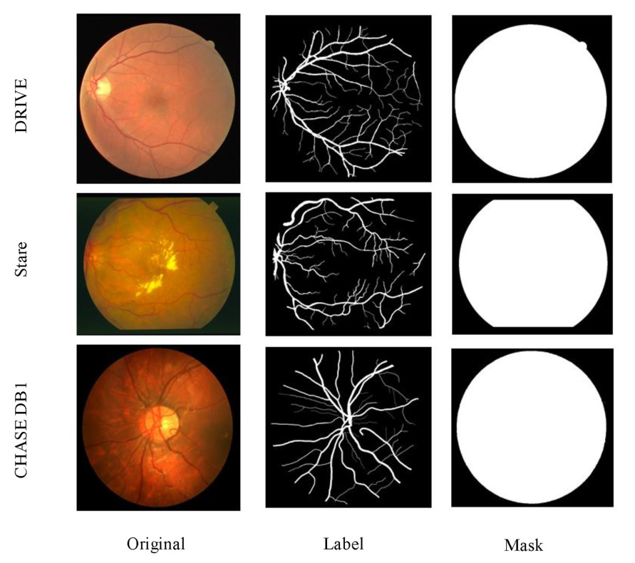 An improved U-Net model with multiscale fusion for retinal vessel segmentation