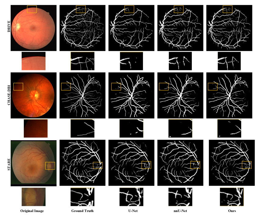 An improved U-Net model with multiscale fusion for retinal vessel segmentation