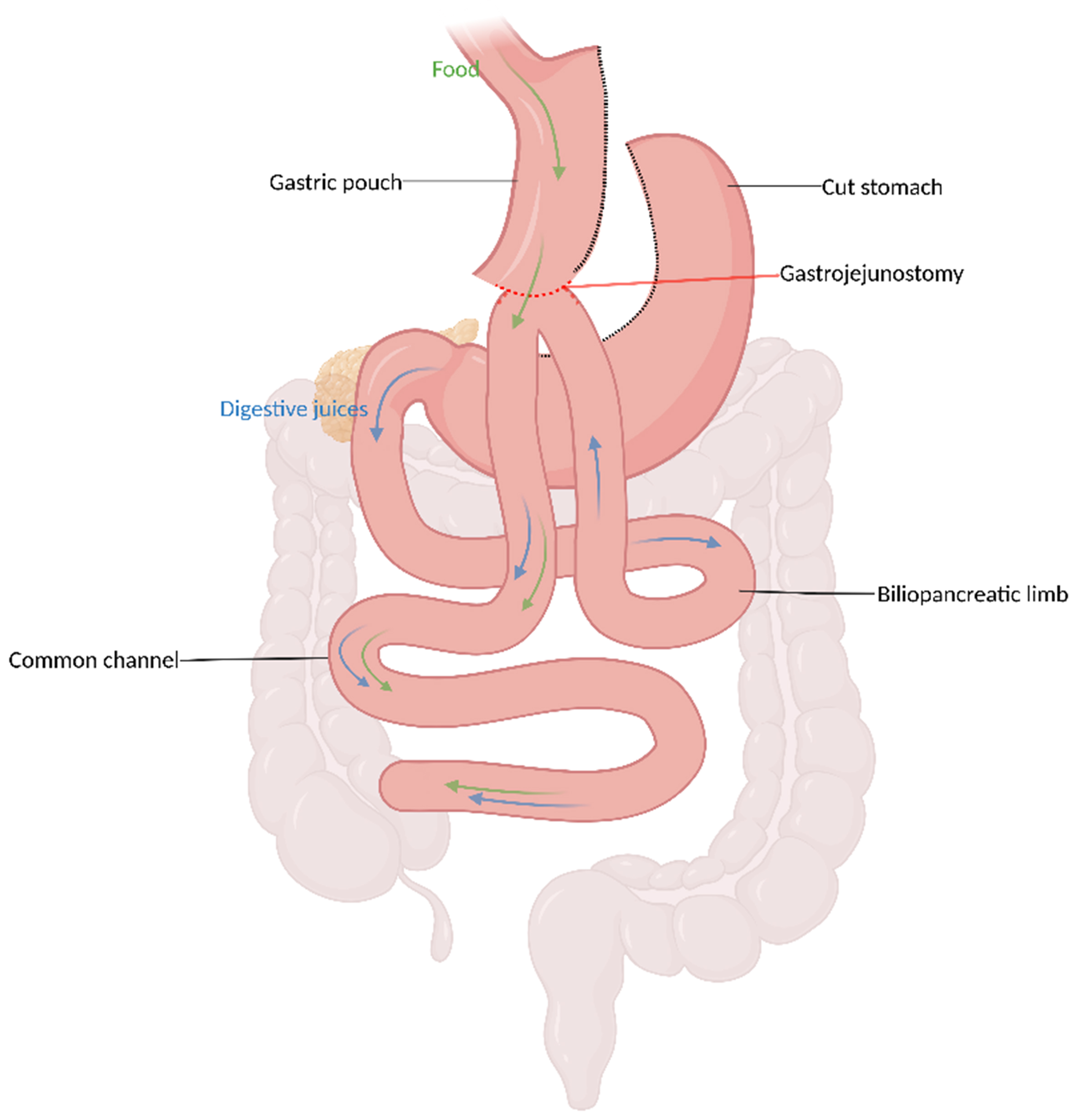 Mid- and long-term outcomes of hypoabsorptive metabolic and bariatric procedures