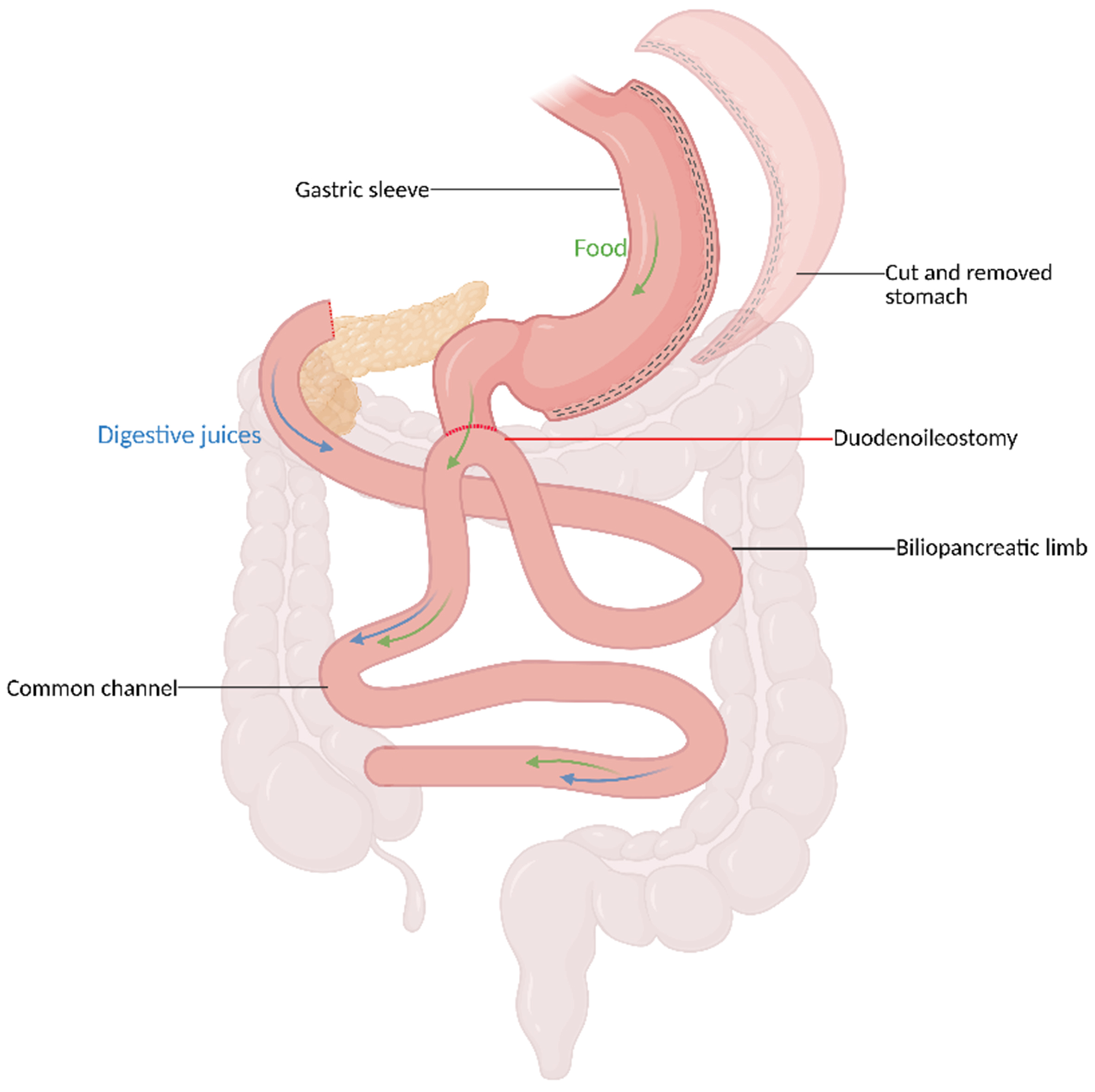 Mid- and long-term outcomes of hypoabsorptive metabolic and bariatric procedures