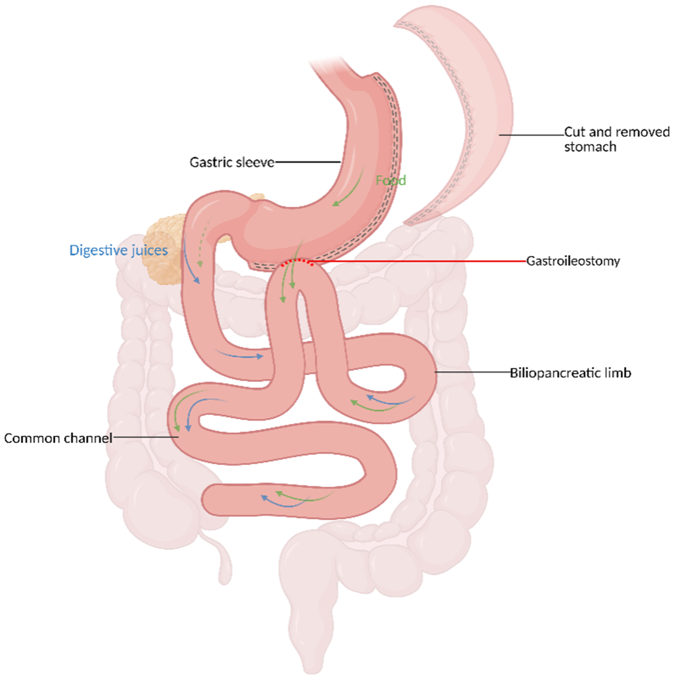 Mid- and long-term outcomes of hypoabsorptive metabolic and bariatric procedures