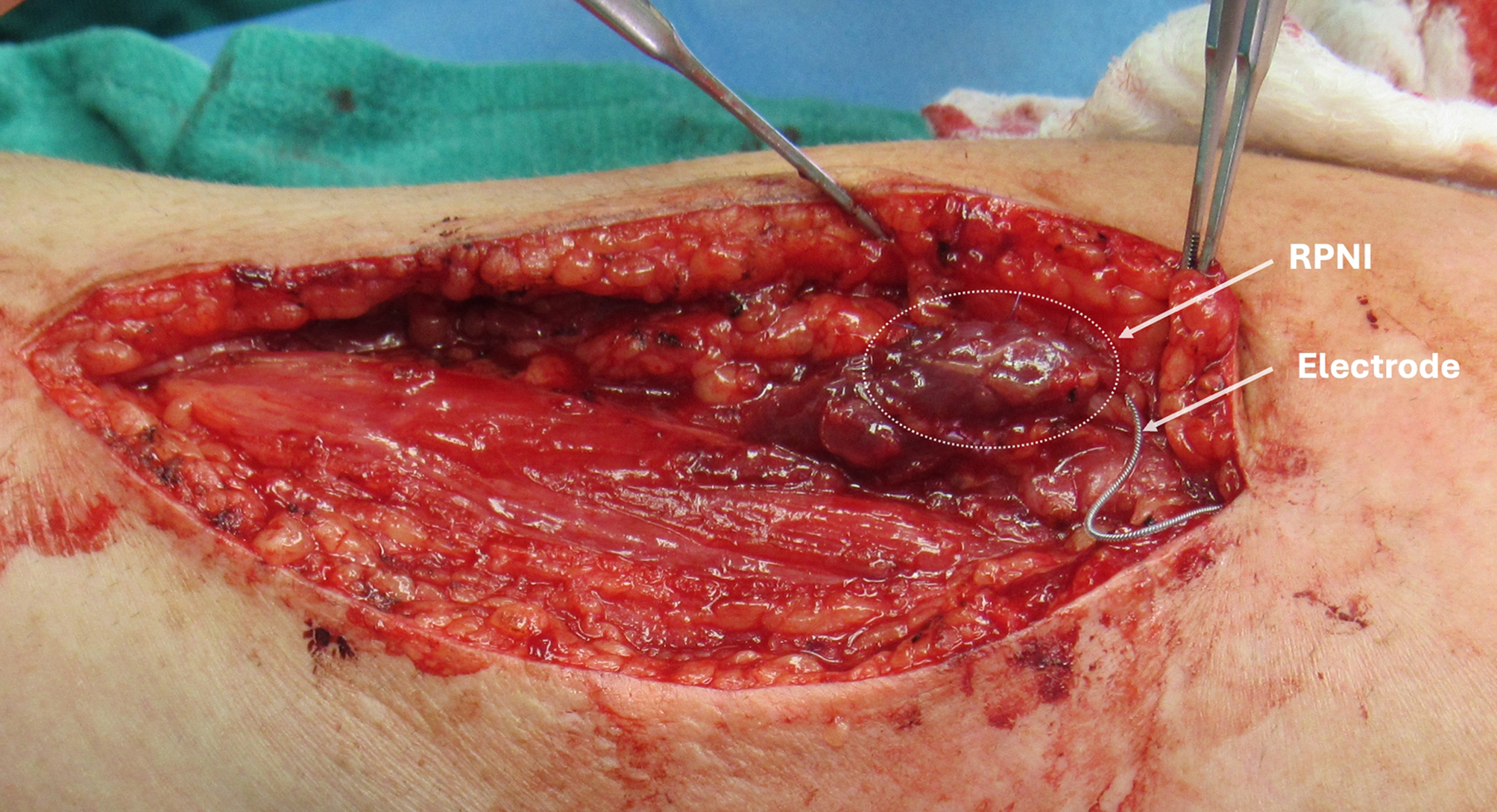 Machine learning for Regenerative Peripheral Nerve Interface-based prosthetic control: current applications and clinical translation