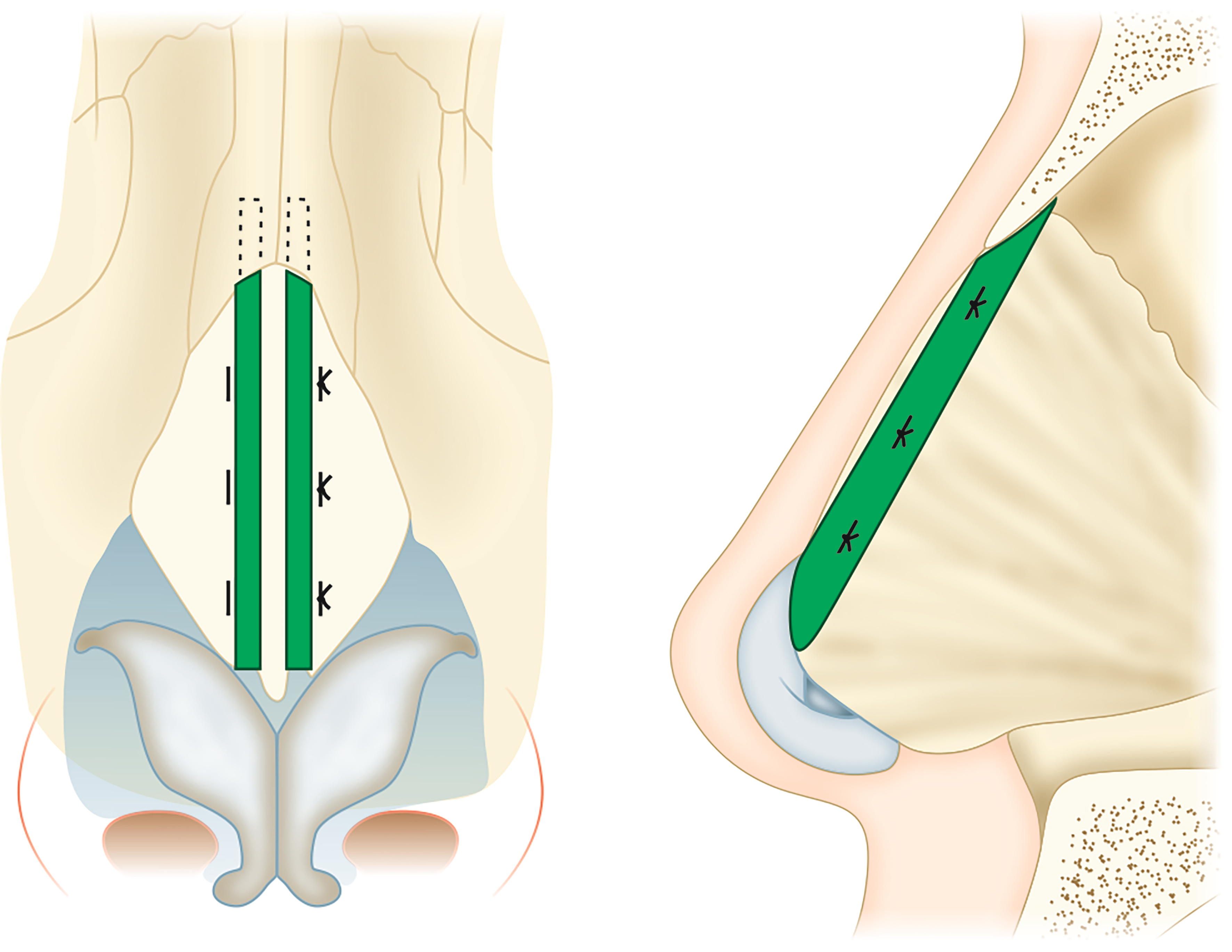 Strategic grafting in rhinoplasty