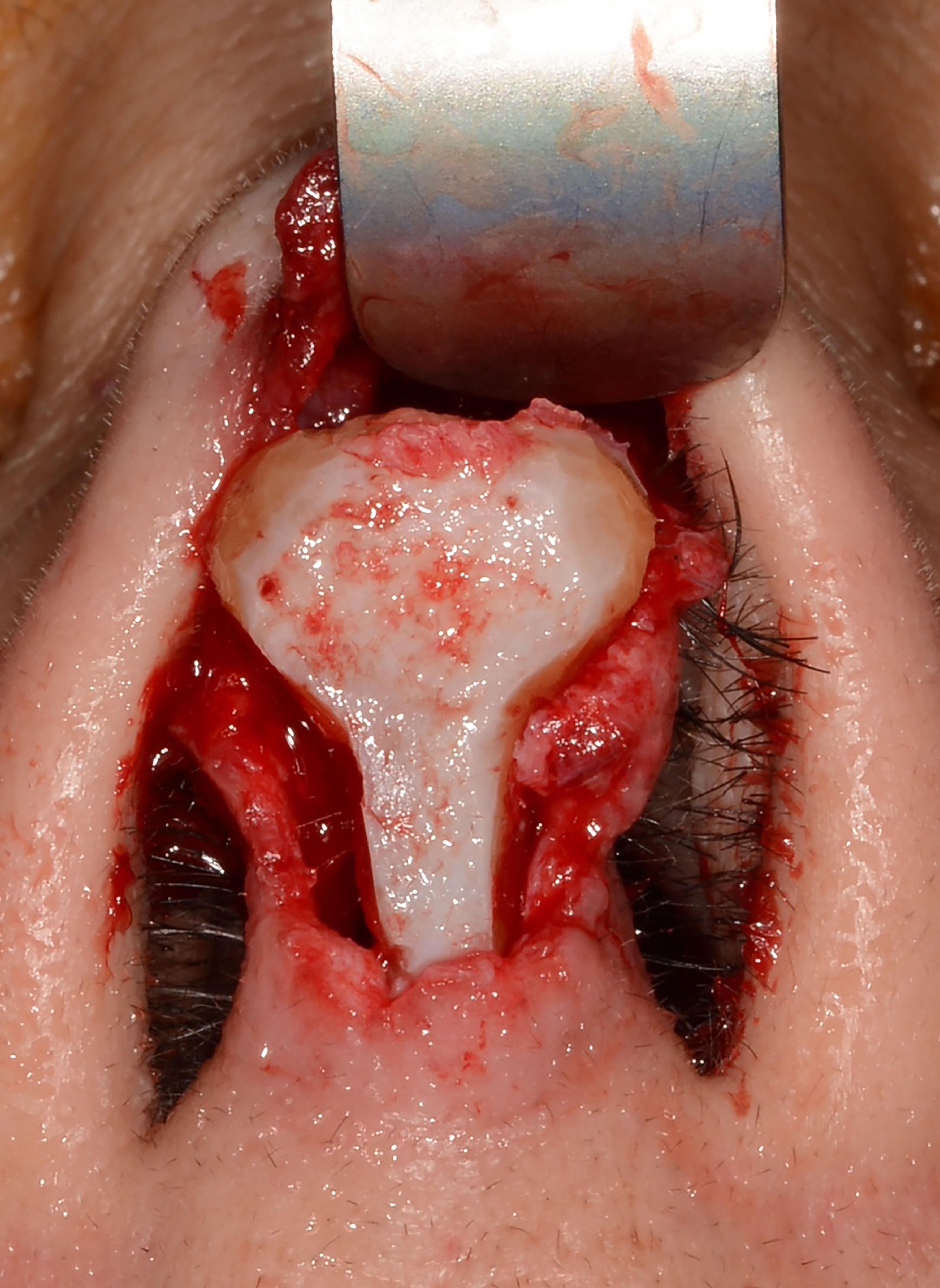 Strategic grafting in rhinoplasty
