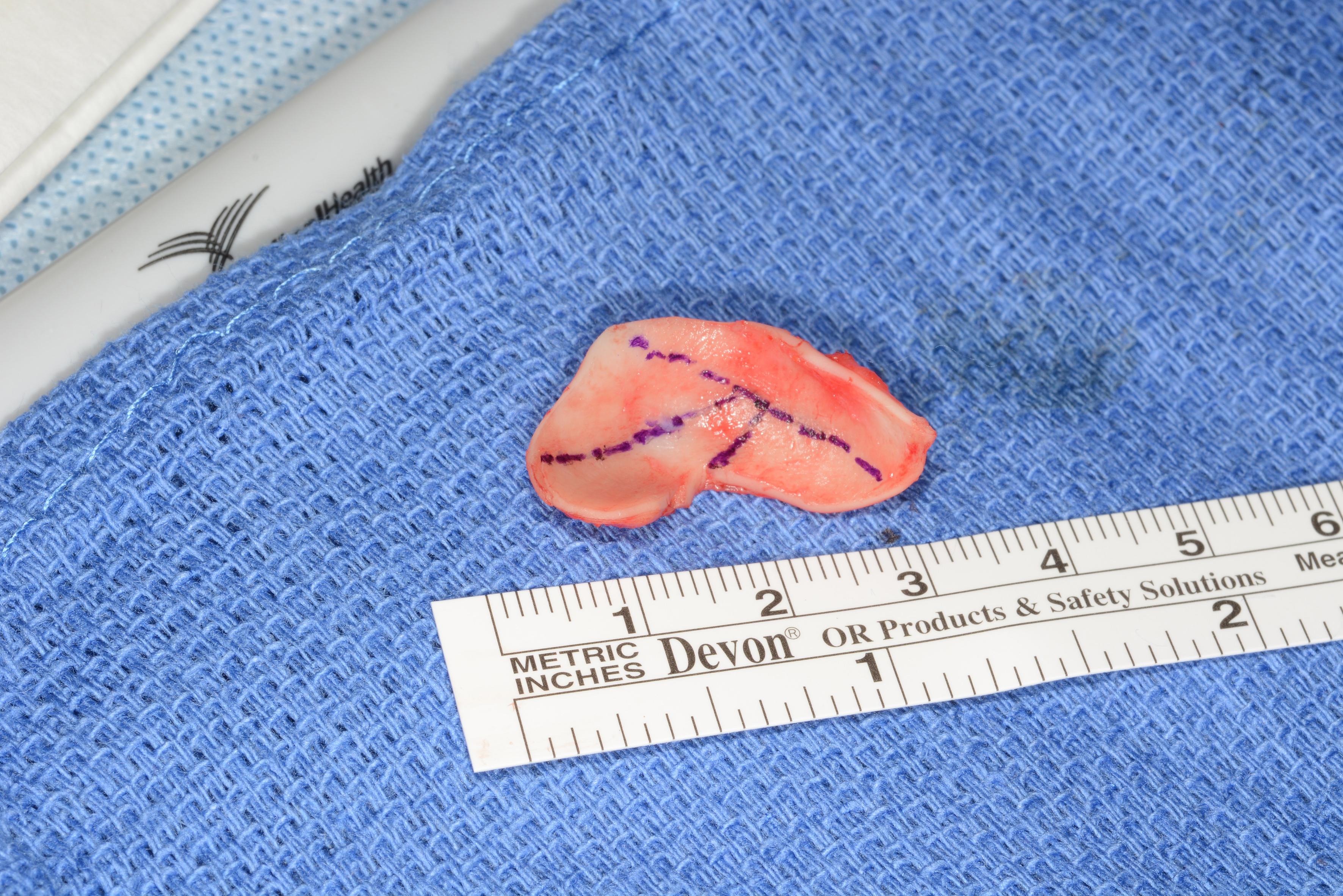 Strategic grafting in rhinoplasty