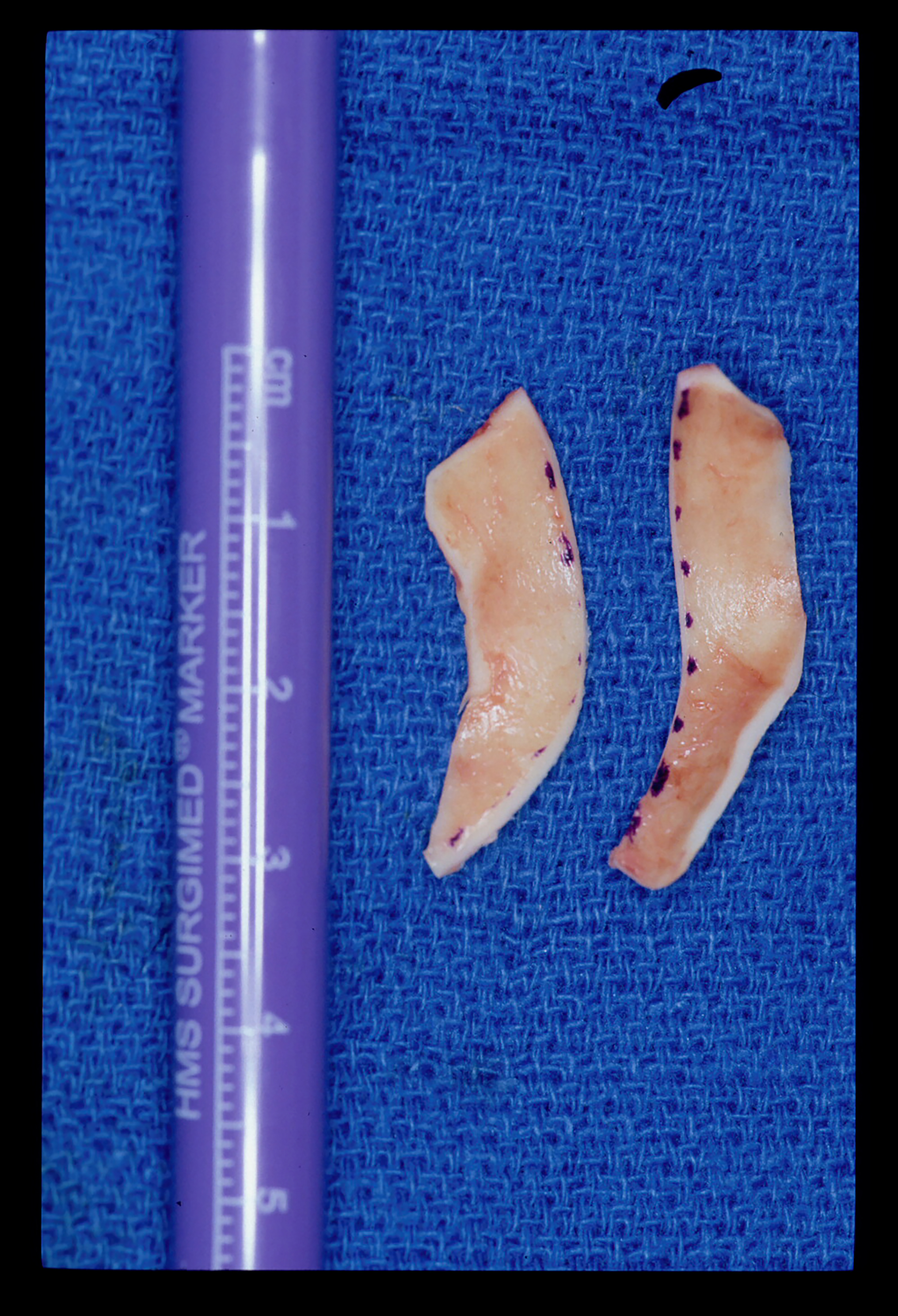 Strategic grafting in rhinoplasty