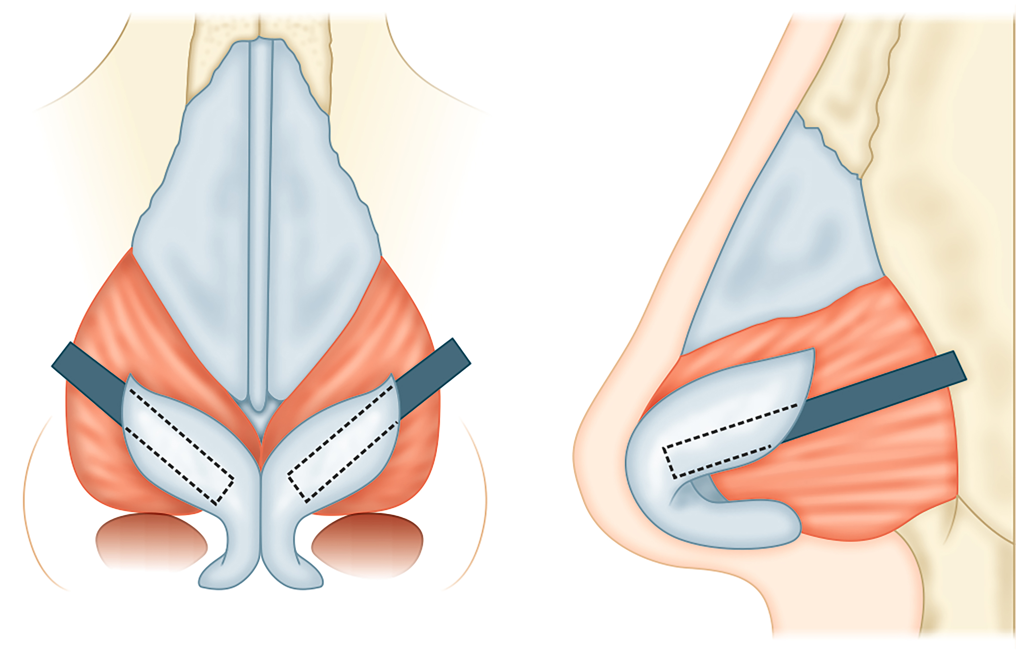 Strategic grafting in rhinoplasty