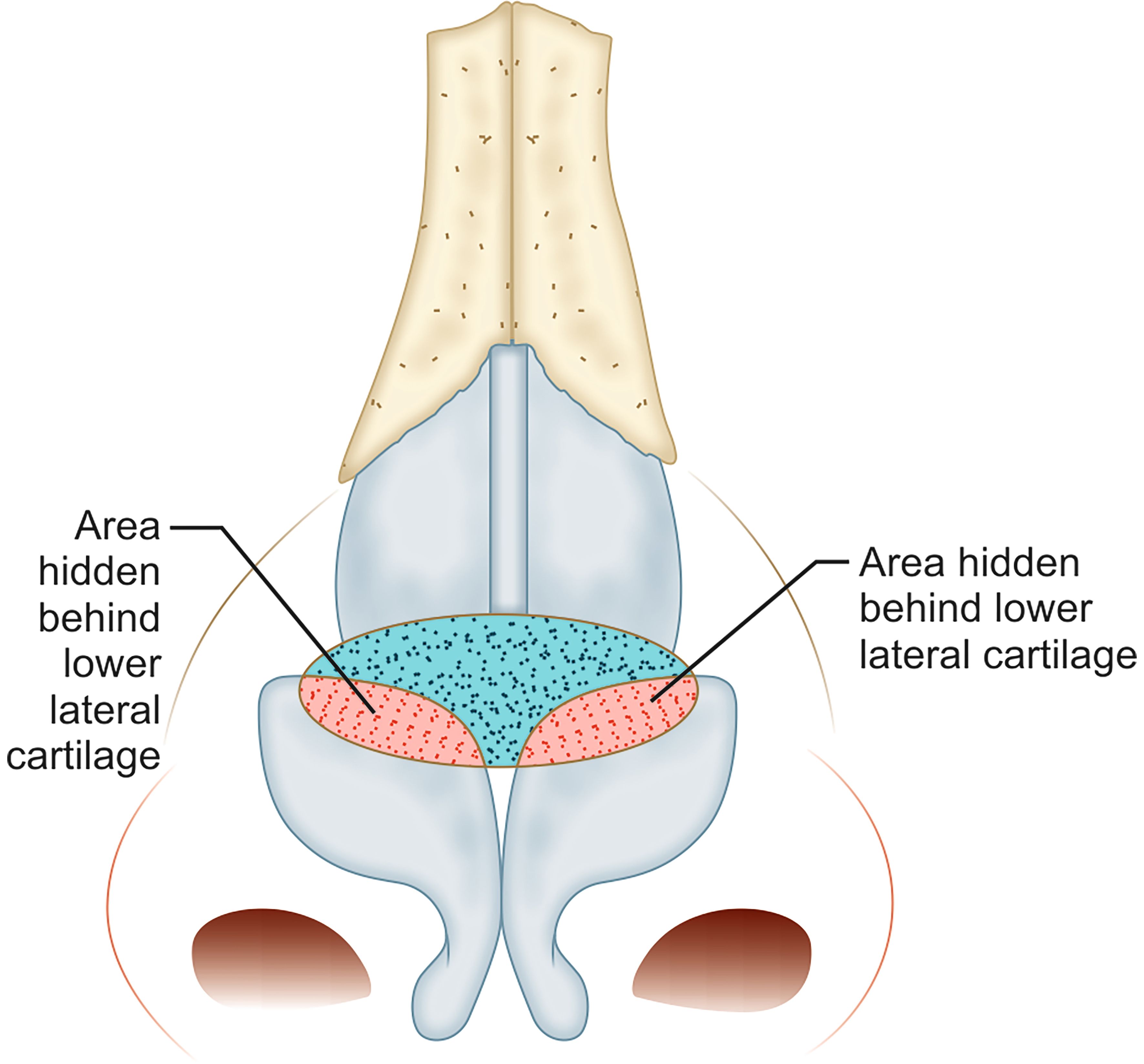 Strategic grafting in rhinoplasty