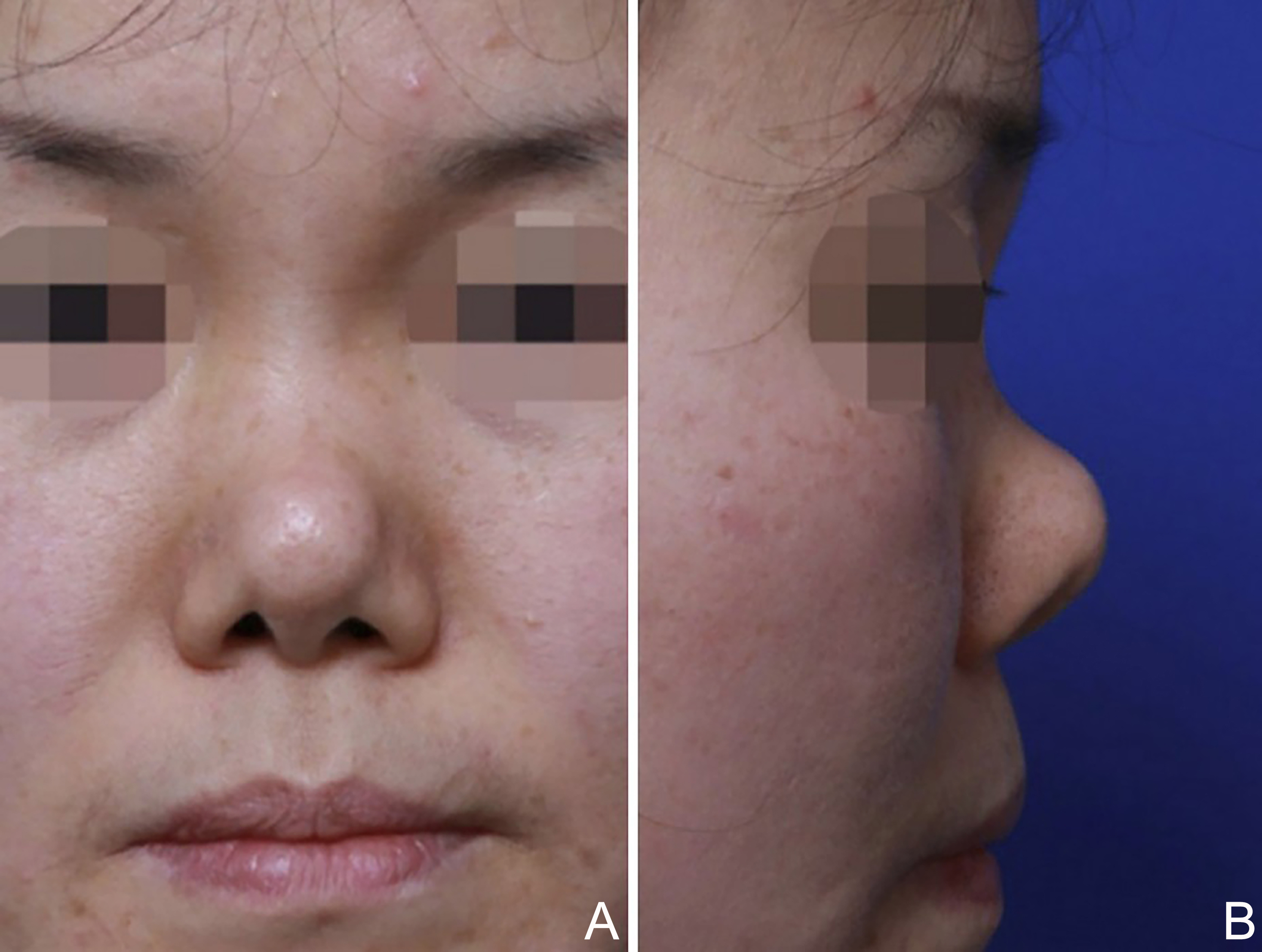 Reconstructive rhinoplasty for the contracted Asian nose