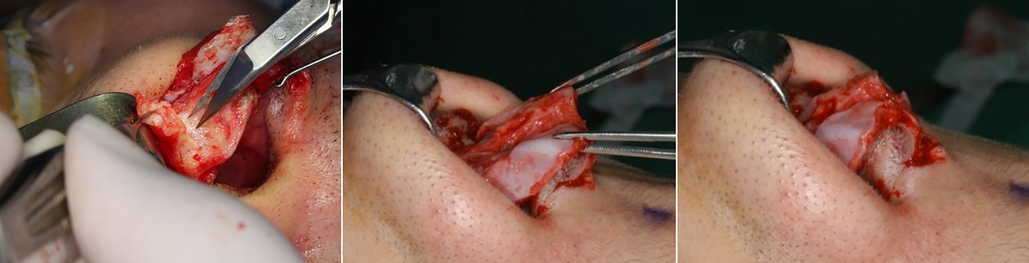 Reconstructive rhinoplasty for the contracted Asian nose