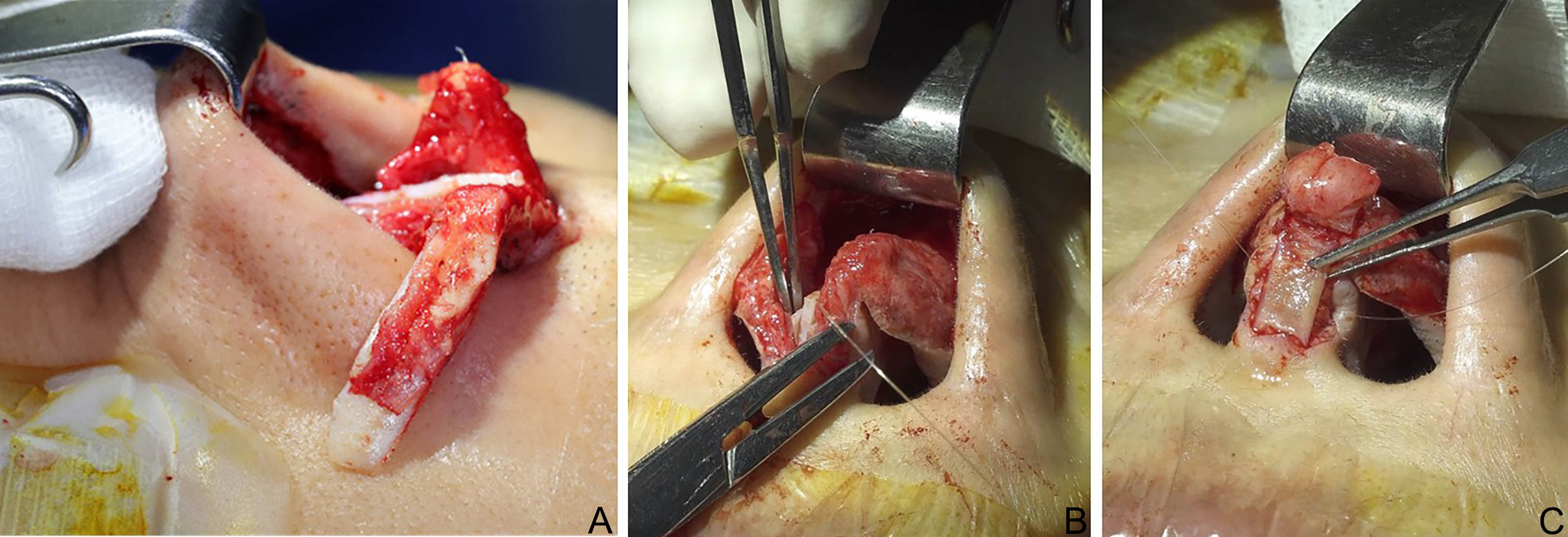 Reconstructive rhinoplasty for the contracted Asian nose