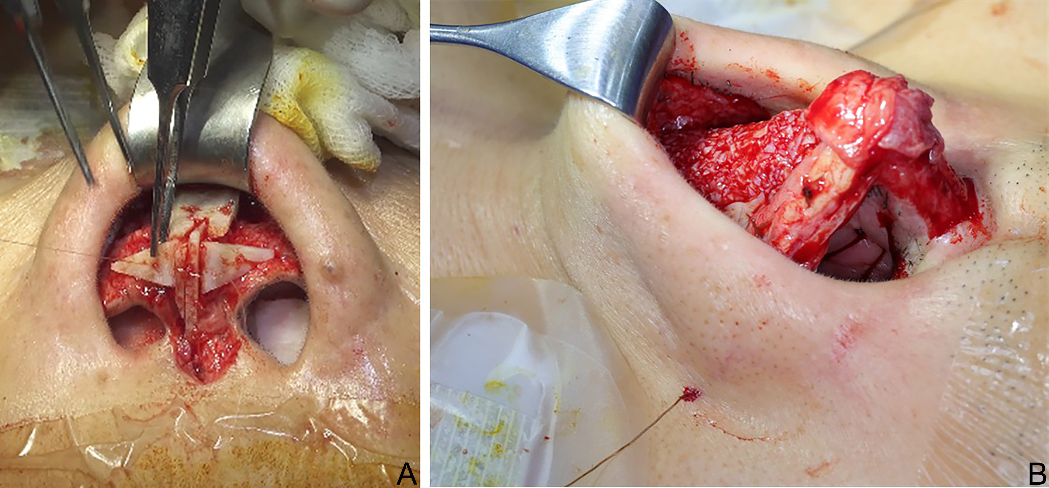 Reconstructive rhinoplasty for the contracted Asian nose