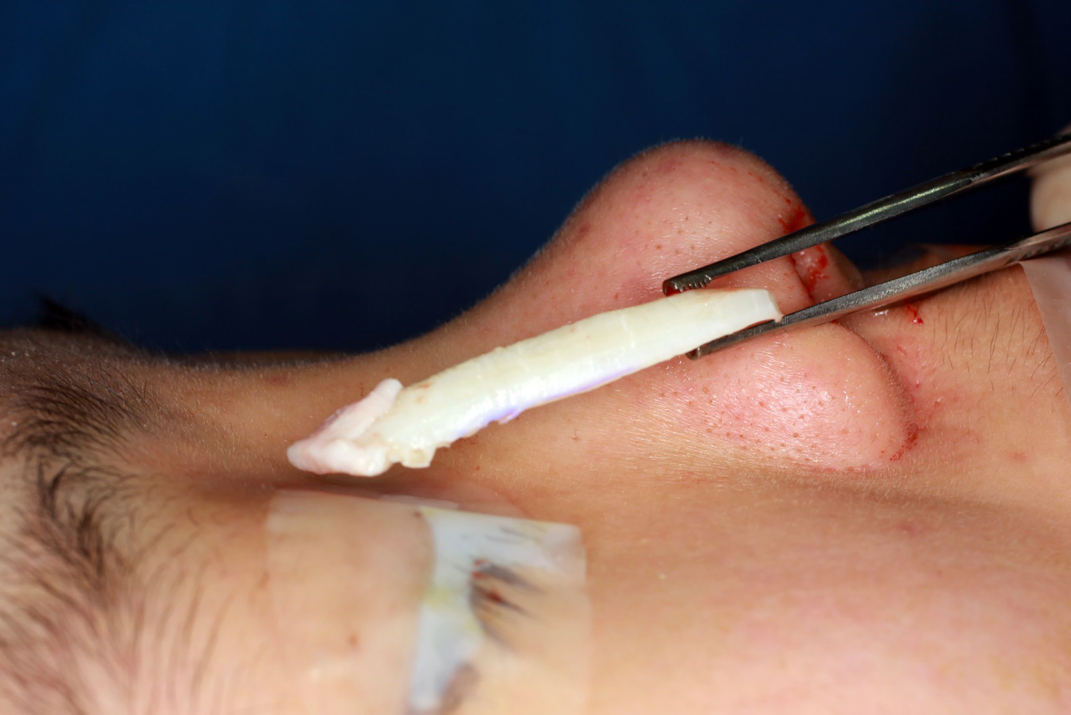 Reconstructive rhinoplasty for the contracted Asian nose