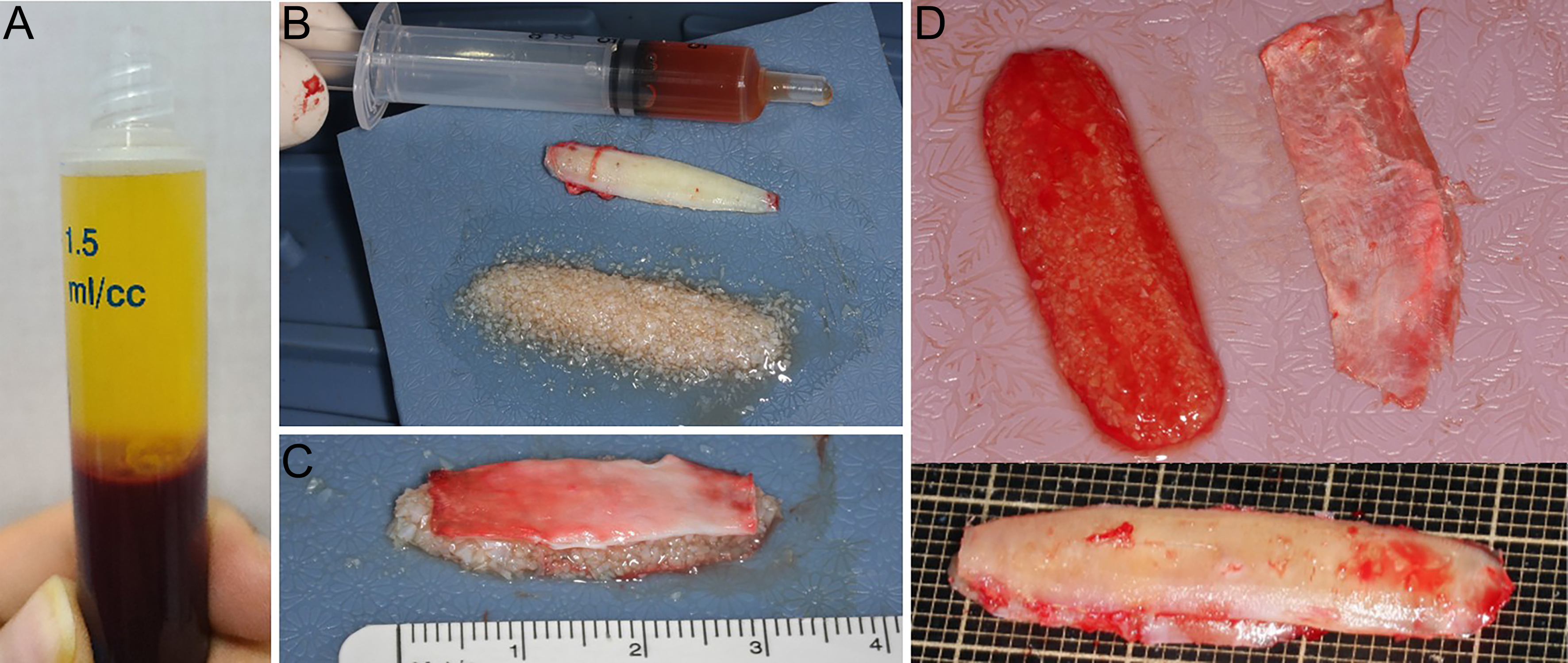 Reconstructive rhinoplasty for the contracted Asian nose