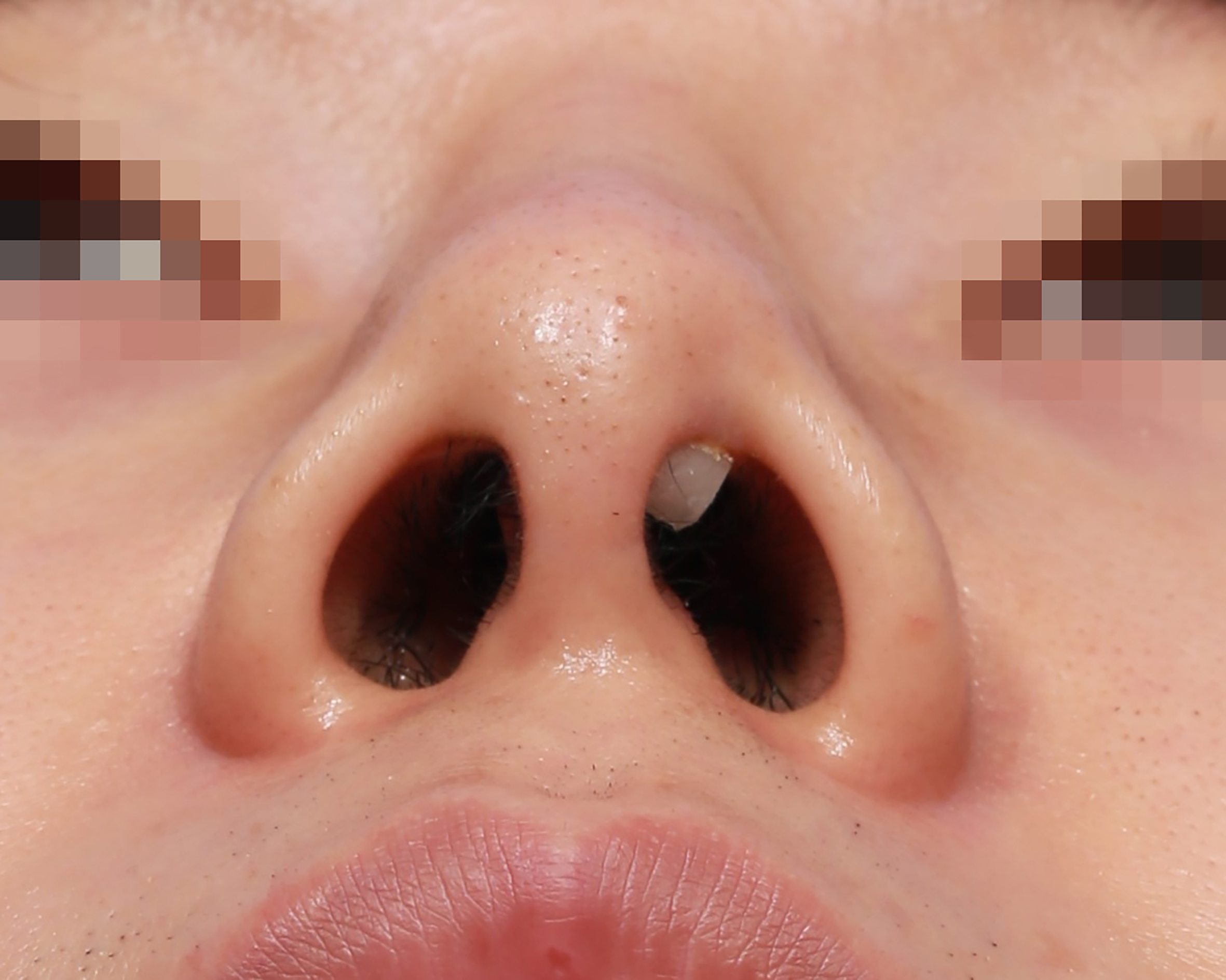 Reconstructive rhinoplasty for the contracted Asian nose