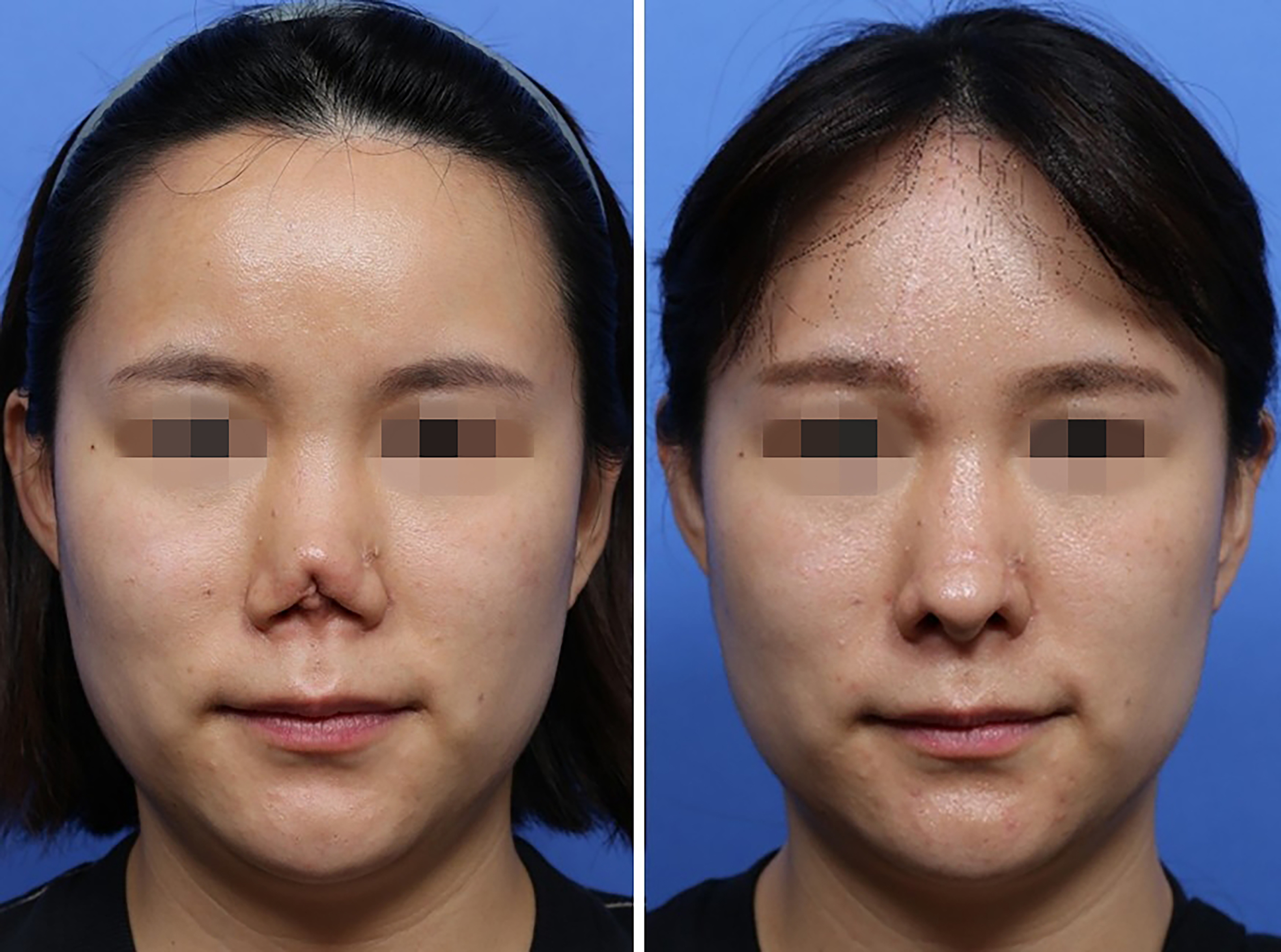 Reconstructive rhinoplasty for the contracted Asian nose