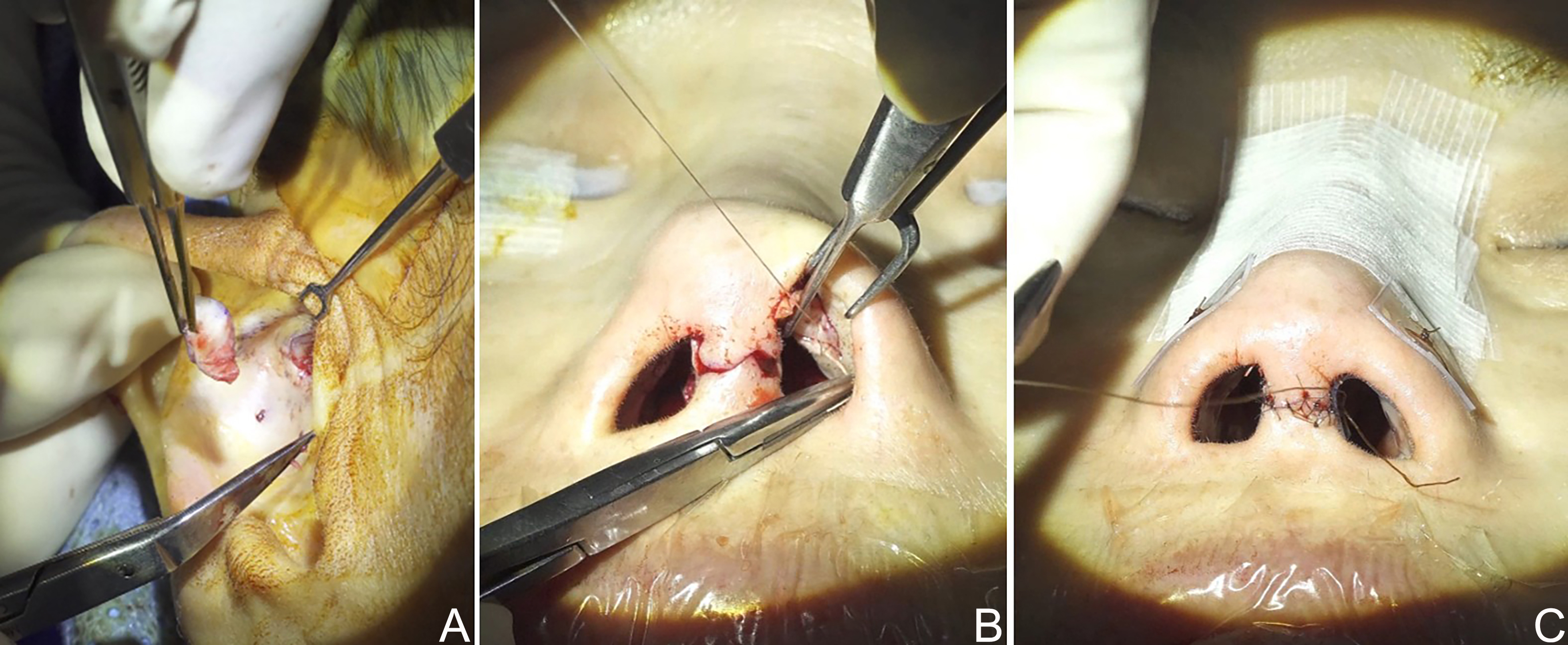Reconstructive rhinoplasty for the contracted Asian nose