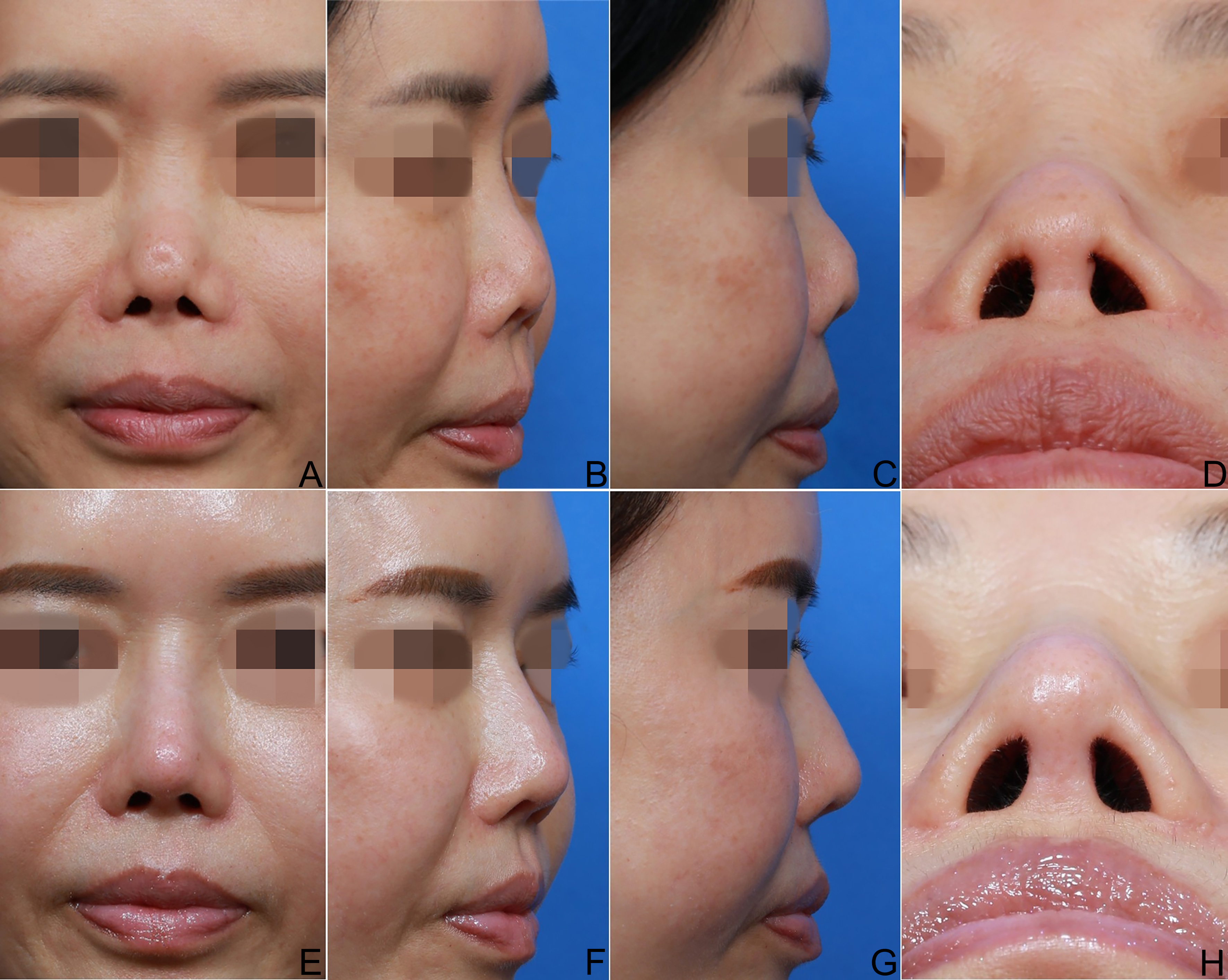 Reconstructive rhinoplasty for the contracted Asian nose