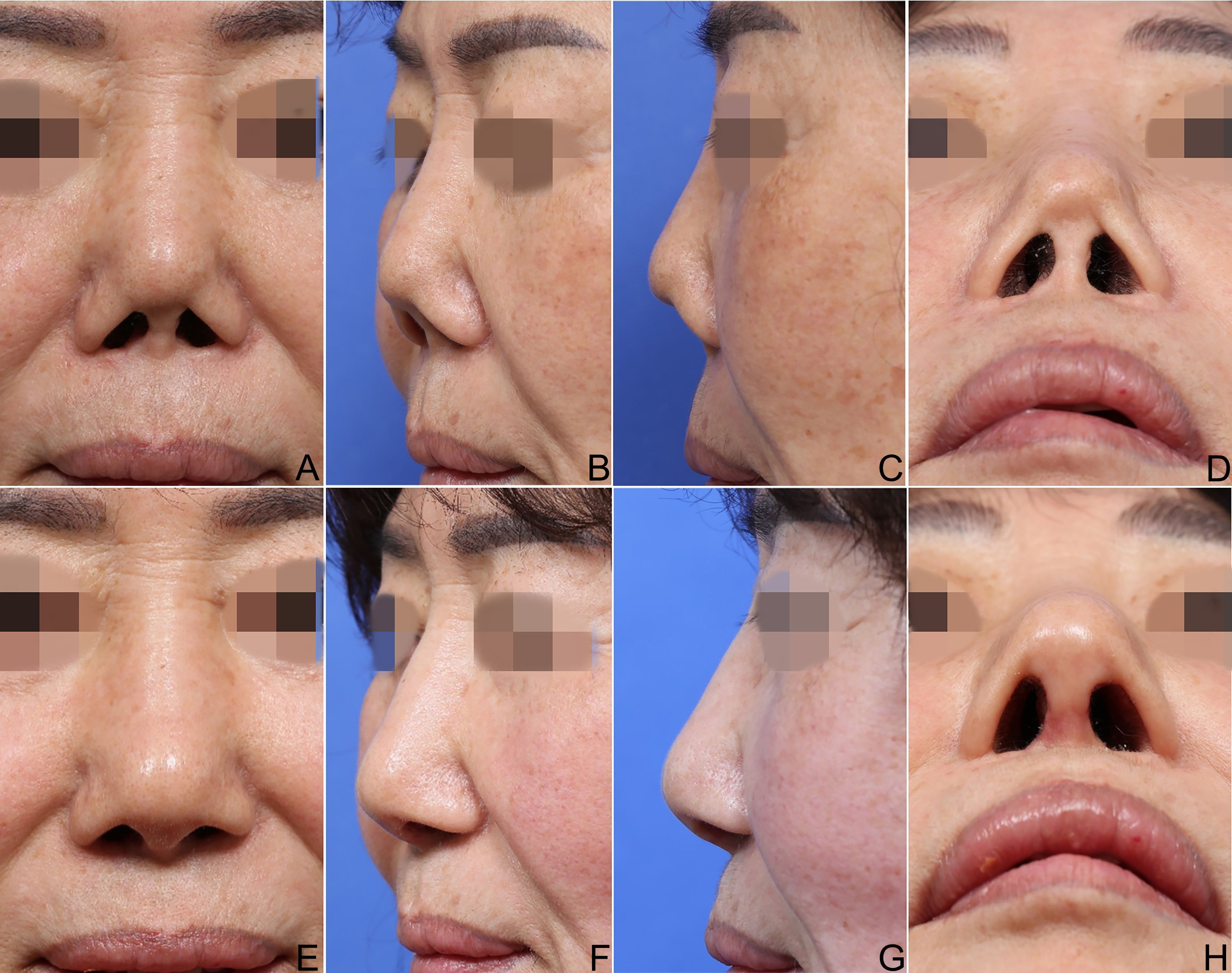 Reconstructive rhinoplasty for the contracted Asian nose